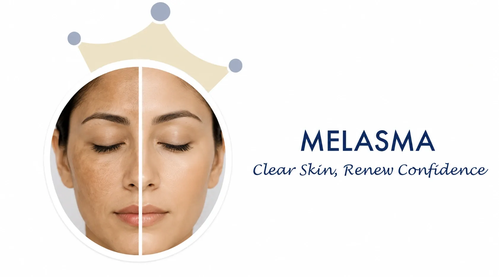 Melasma permanent treatment in Ahmedabad ADORN