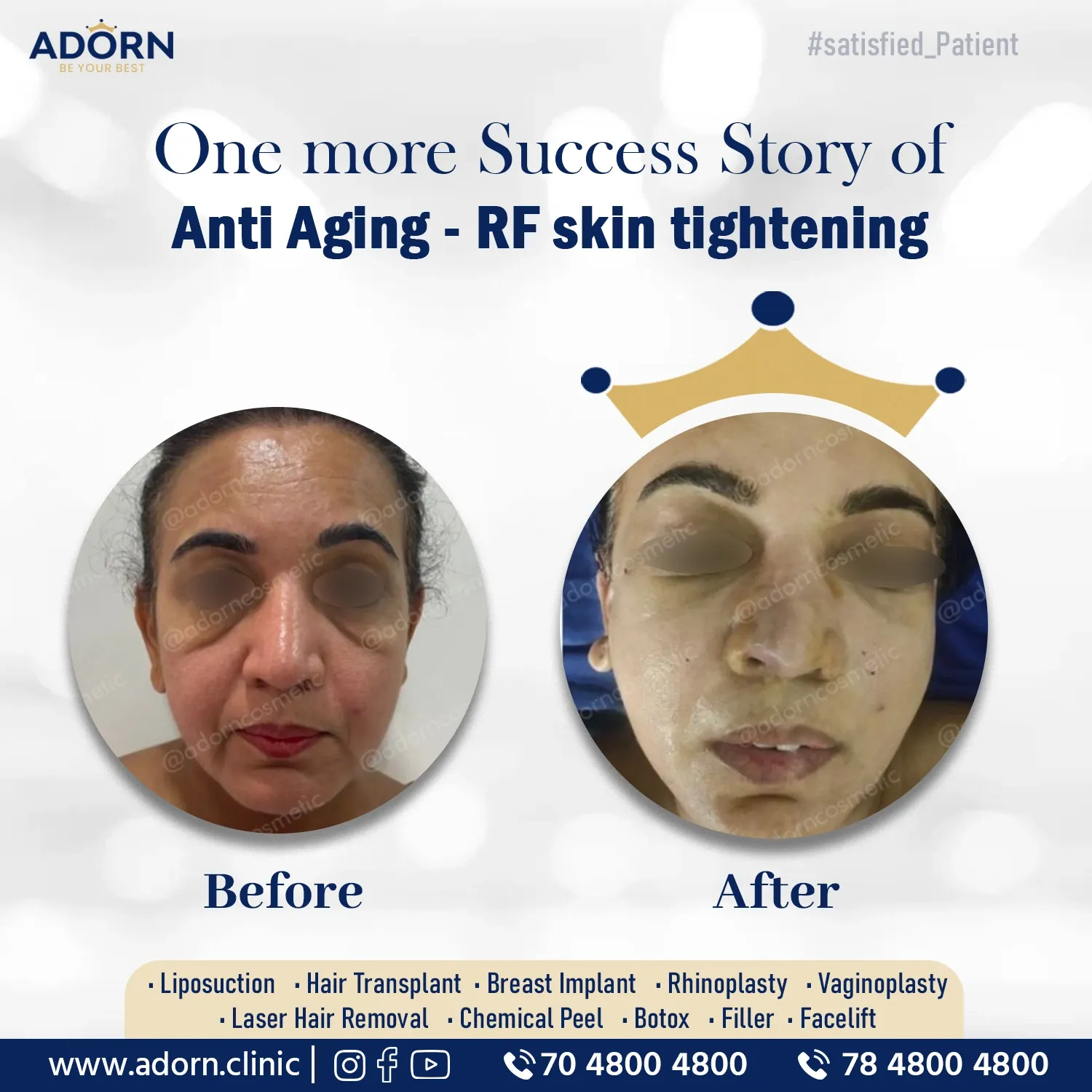 Anti aging skin treatment accutite mnrf morpheus8