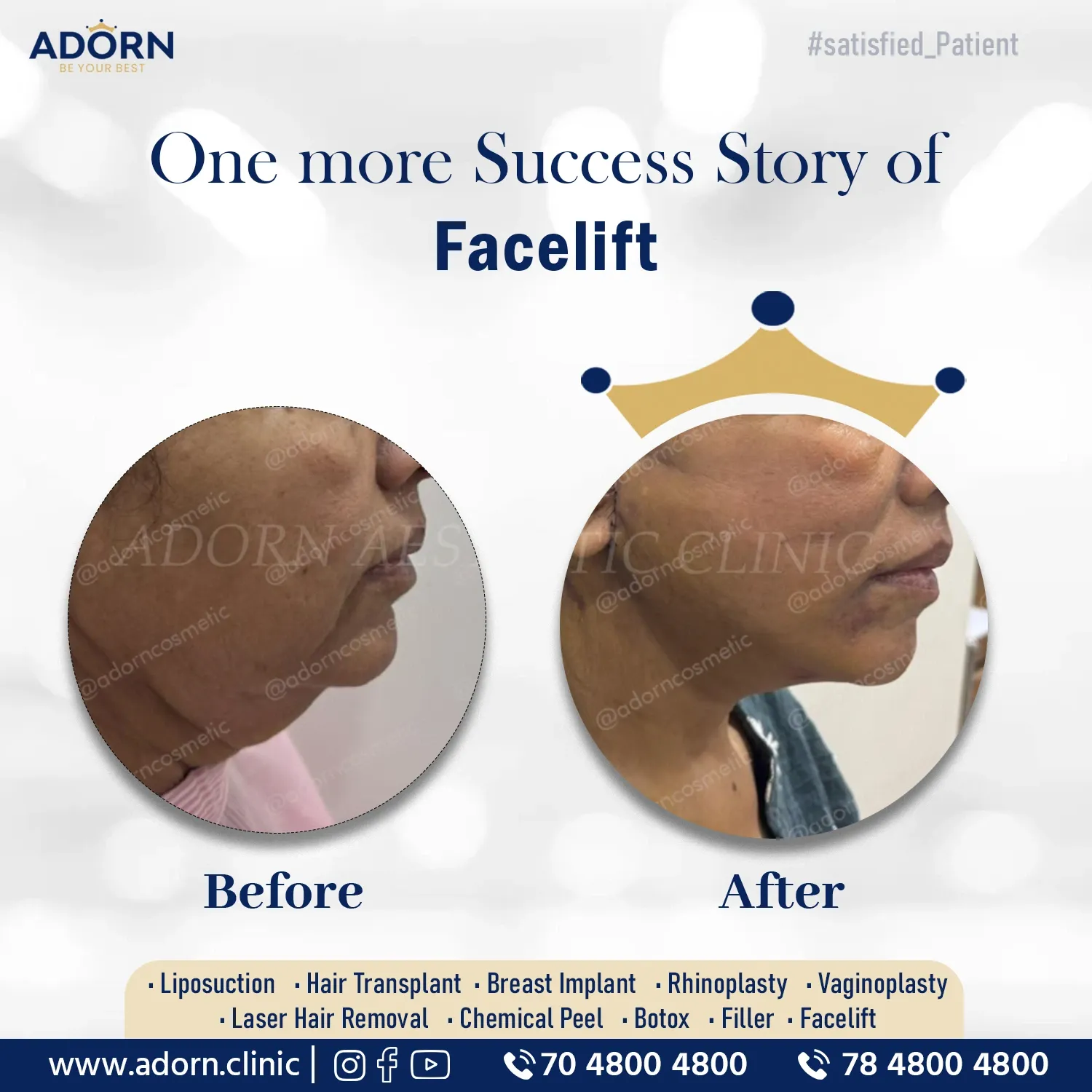 Best Facelift Necklift surgery Ahmedabad India before after results cost