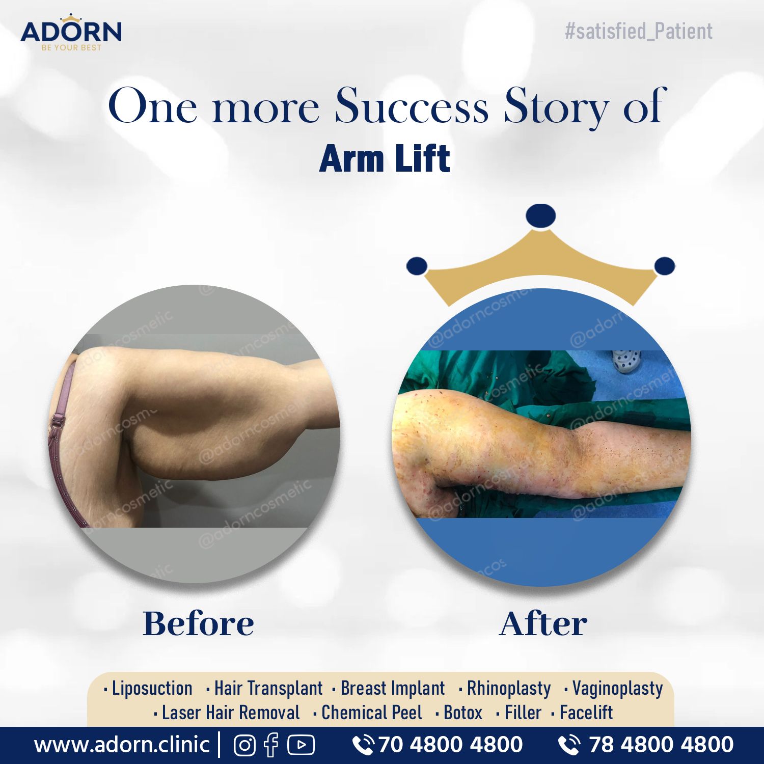 Armlift Surgery Before After results Ahmedabad