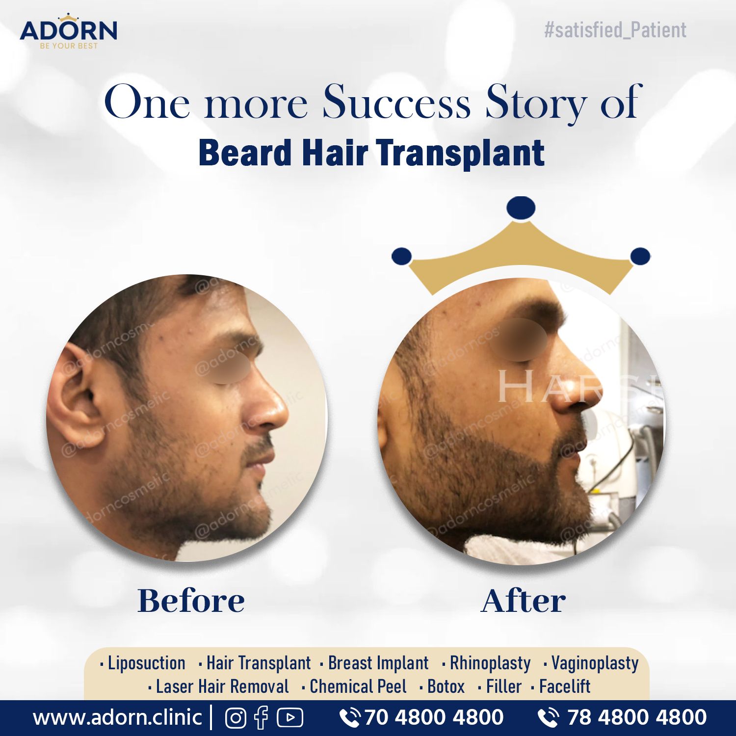 Beard hair transplant before after results Ahmedabad India 