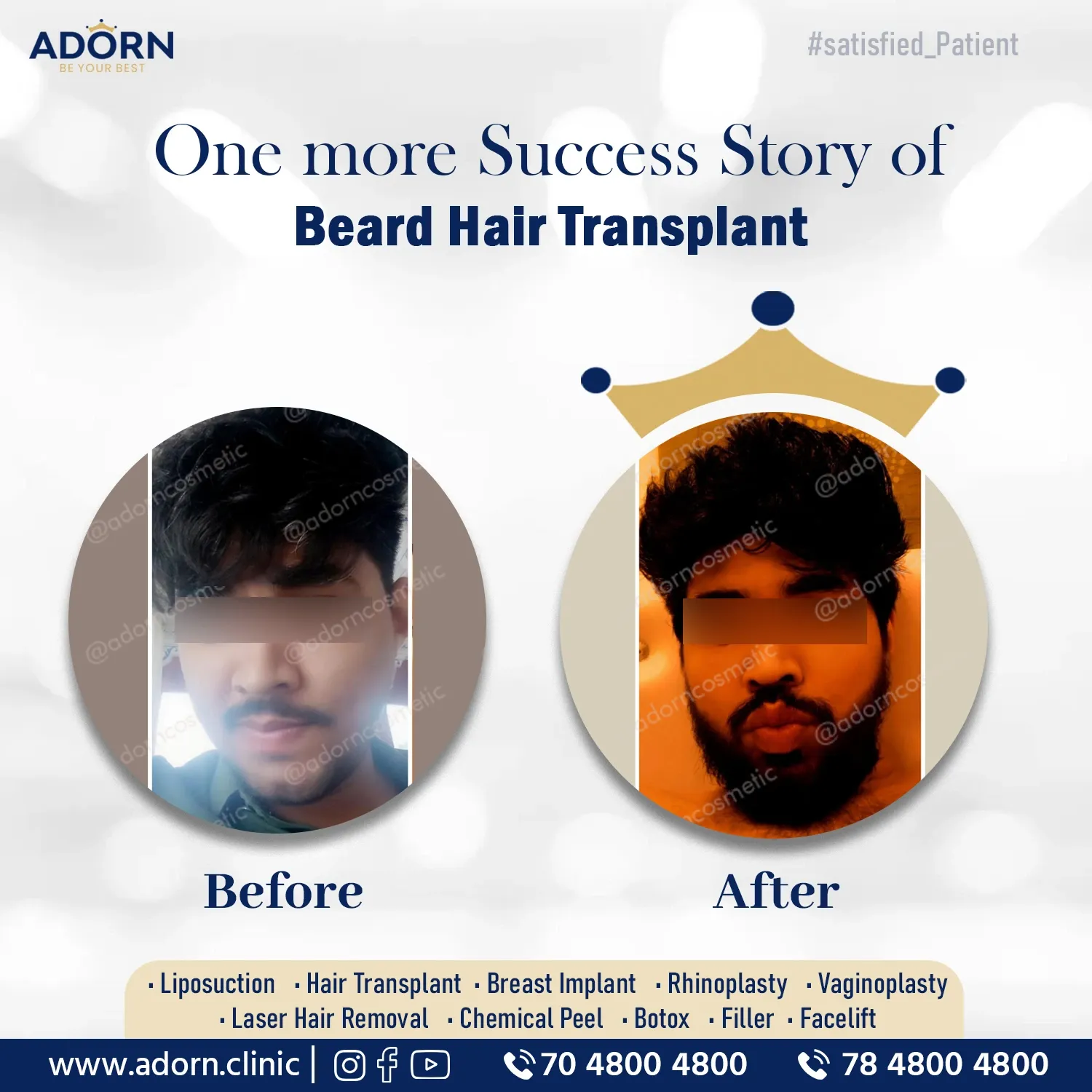 Beard hair transplant before after results Ahmedabad 