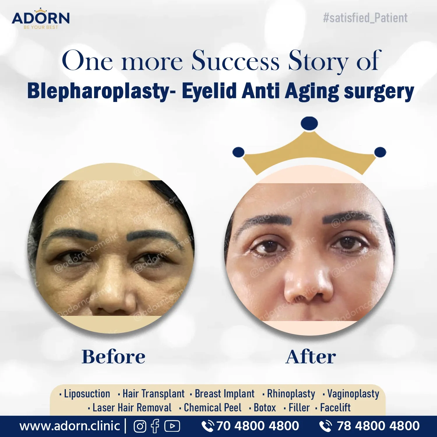  Blepharoplasty Ahmedabad Gujarat India