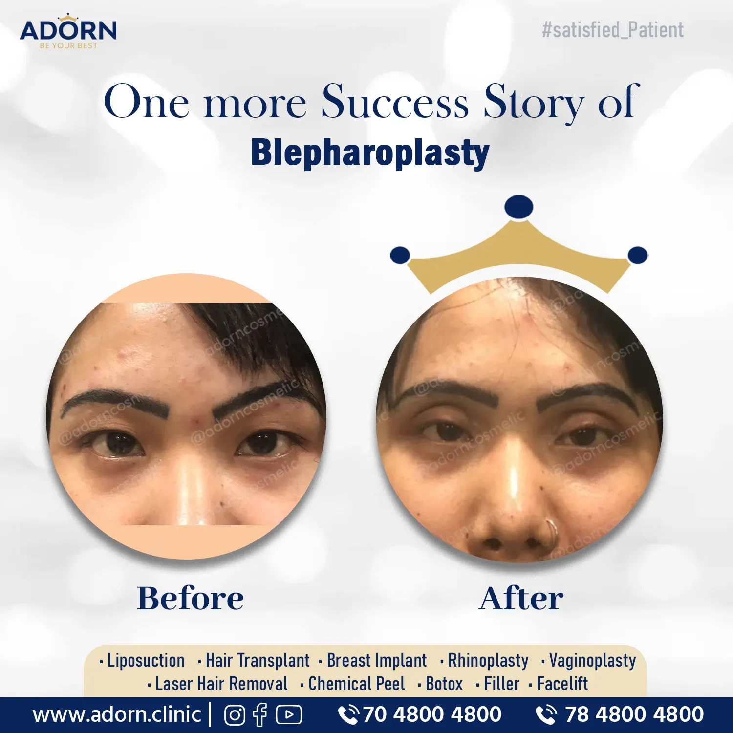 Blepharoplasty before after results Ahmedabad