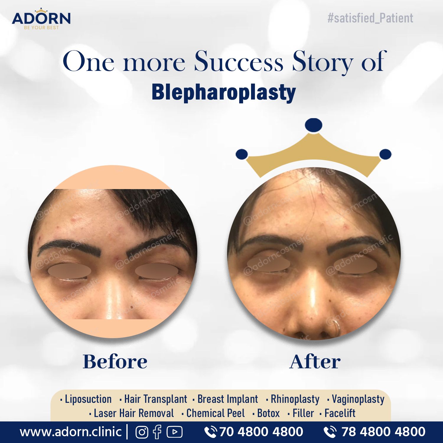 North east eyelid surgery before after results blepharoplasty 