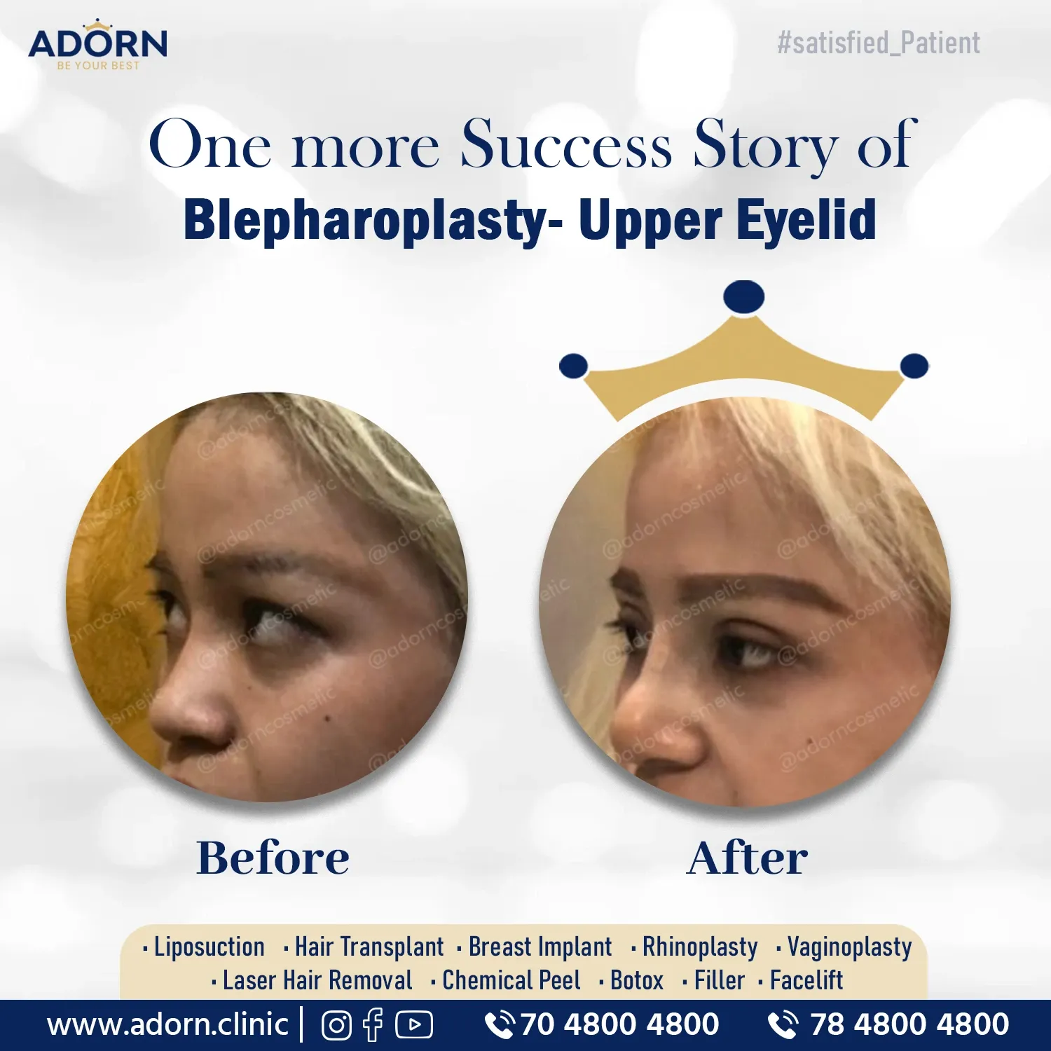 Blepharoplasty India eyelid surgery