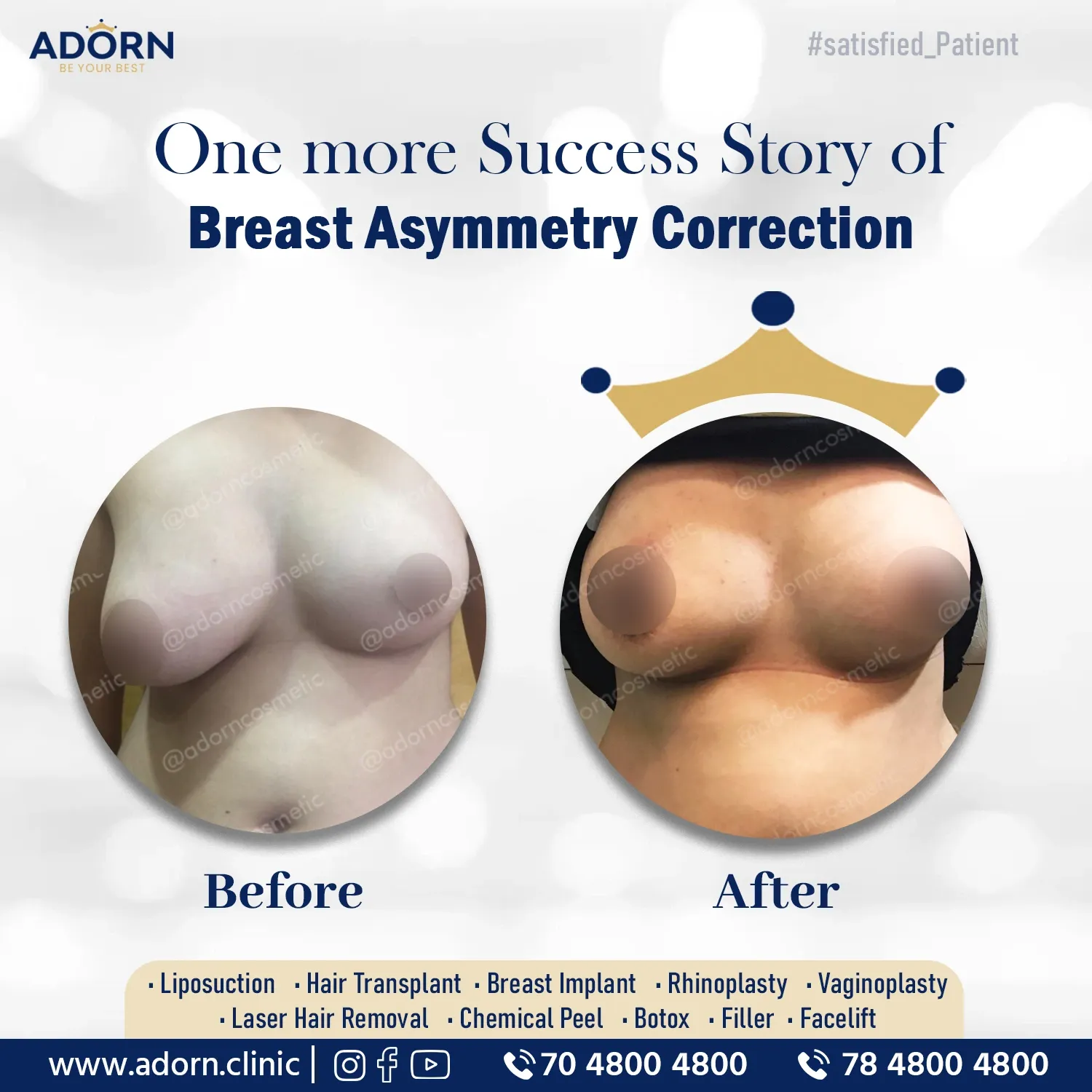Breast asymmetry surgery