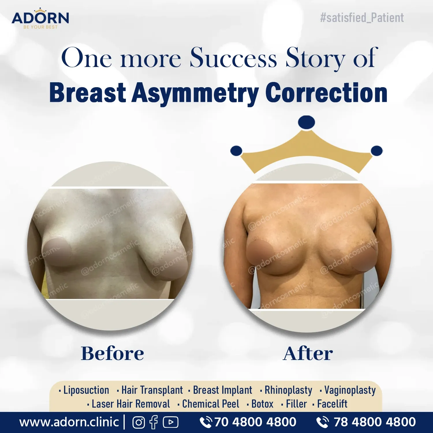 Breast asymmetry surgery