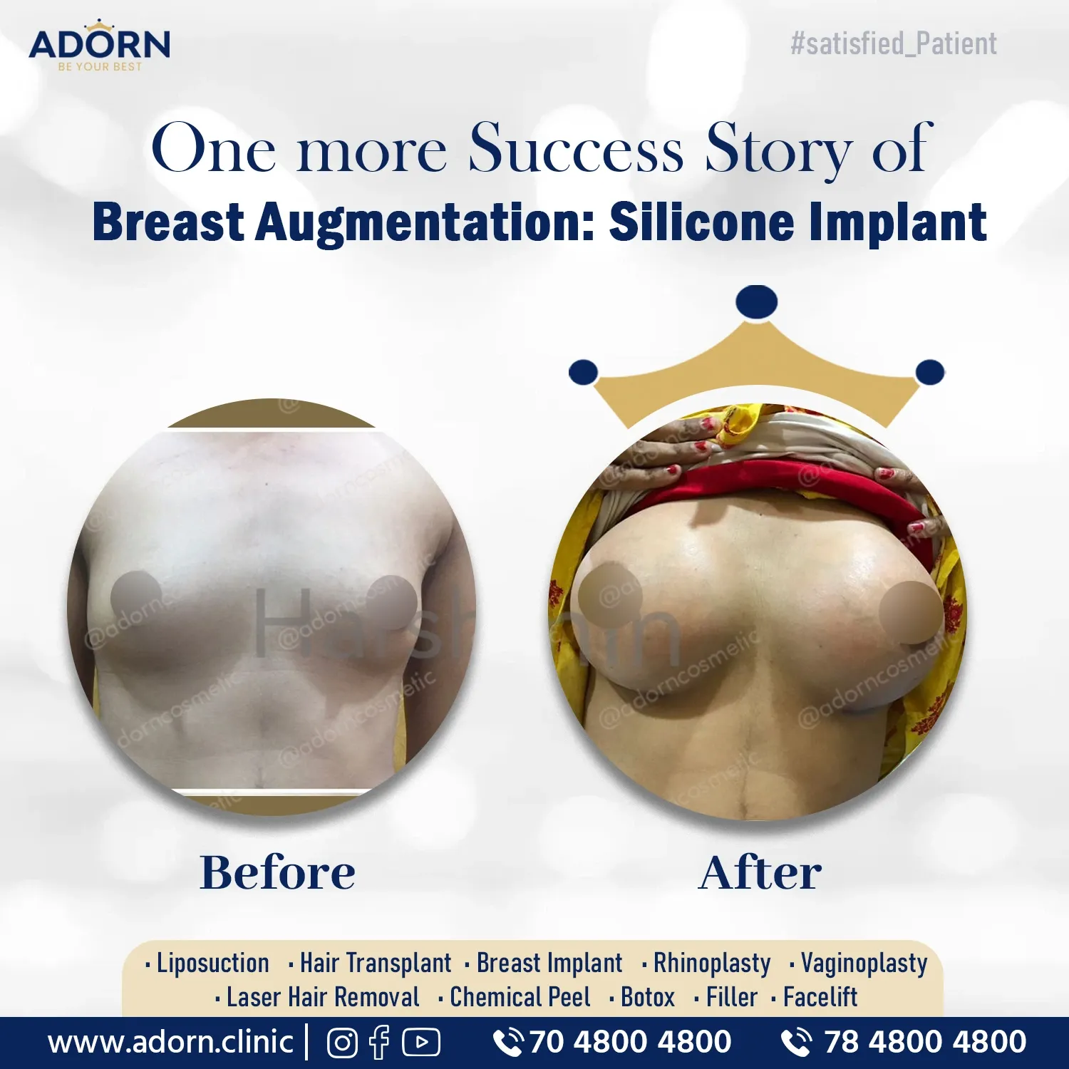 Breast Implant Augmentation before after Ahmedabad India