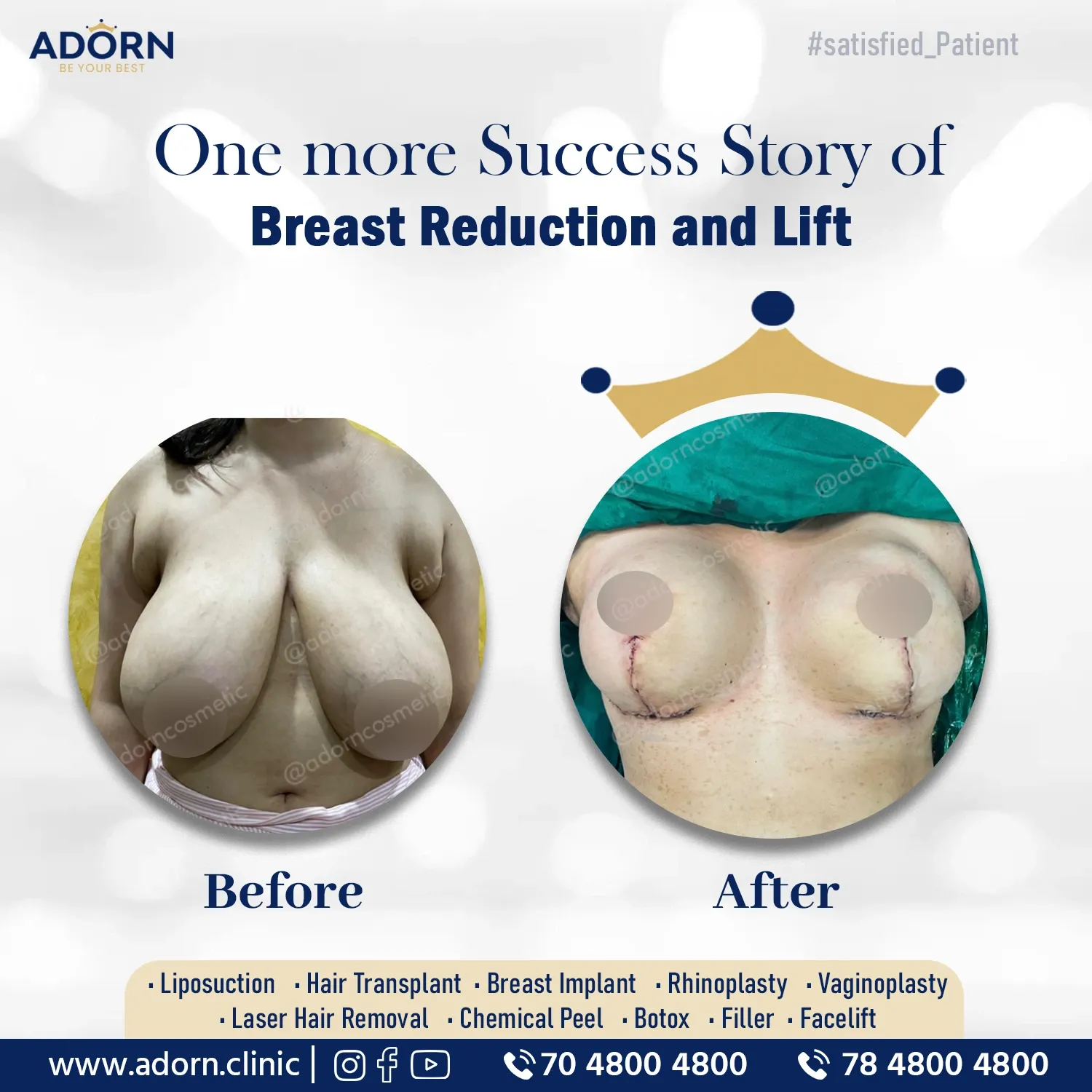Breast reduction Ahmedabad results before after