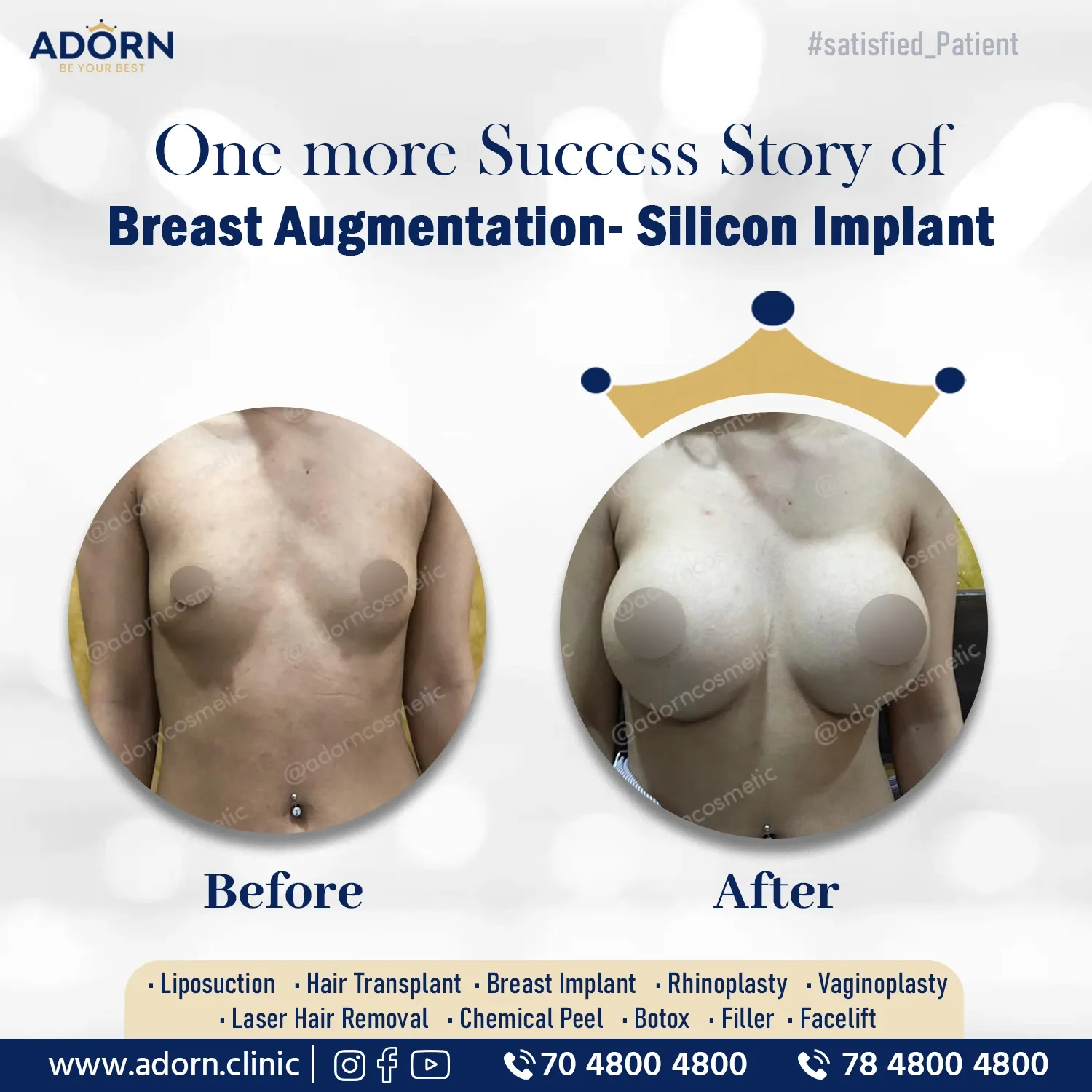 Breast Augmentation before after results Ahmedabad