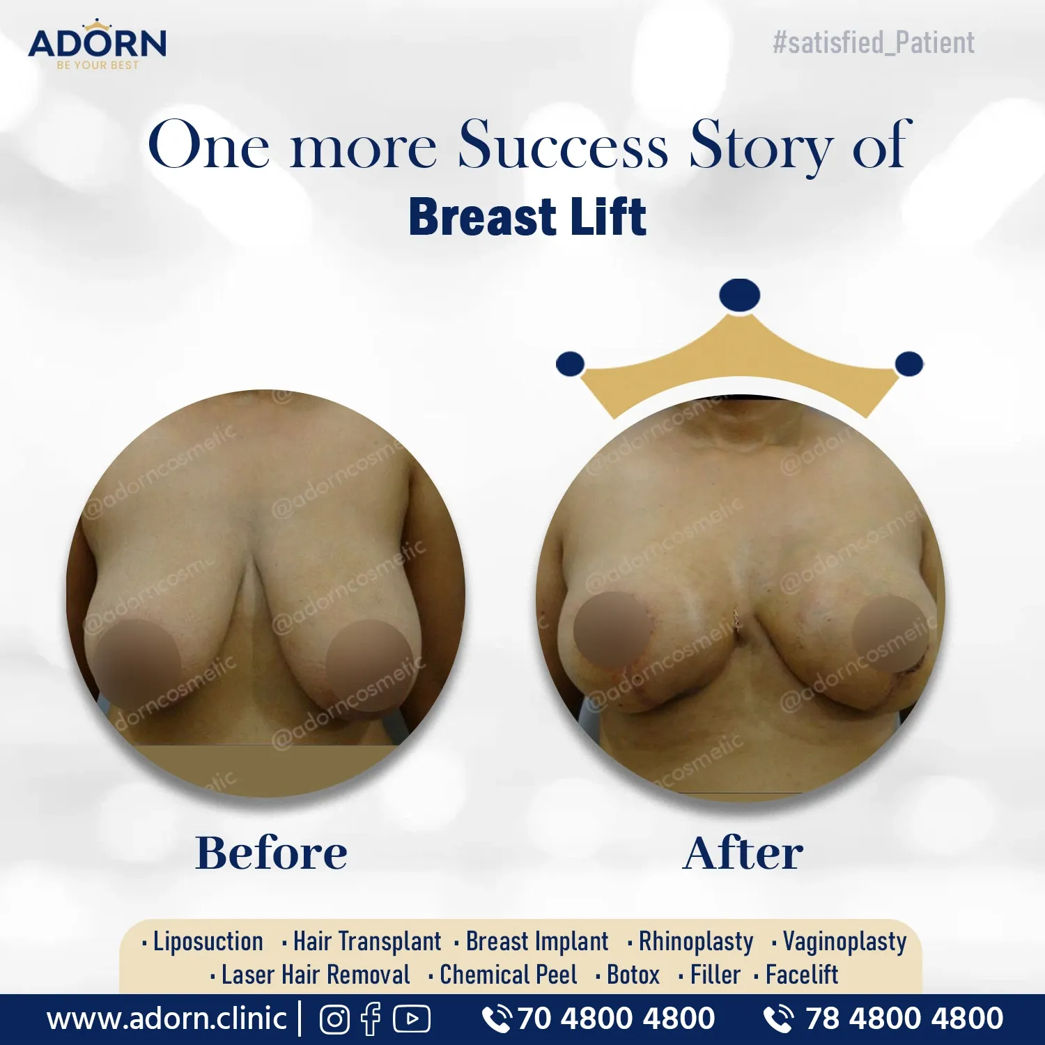 Breast Lift Results before after Ahmedabad