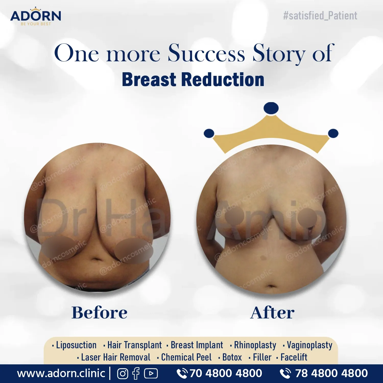Breast reduction Ahmedabad Gujarat results before after