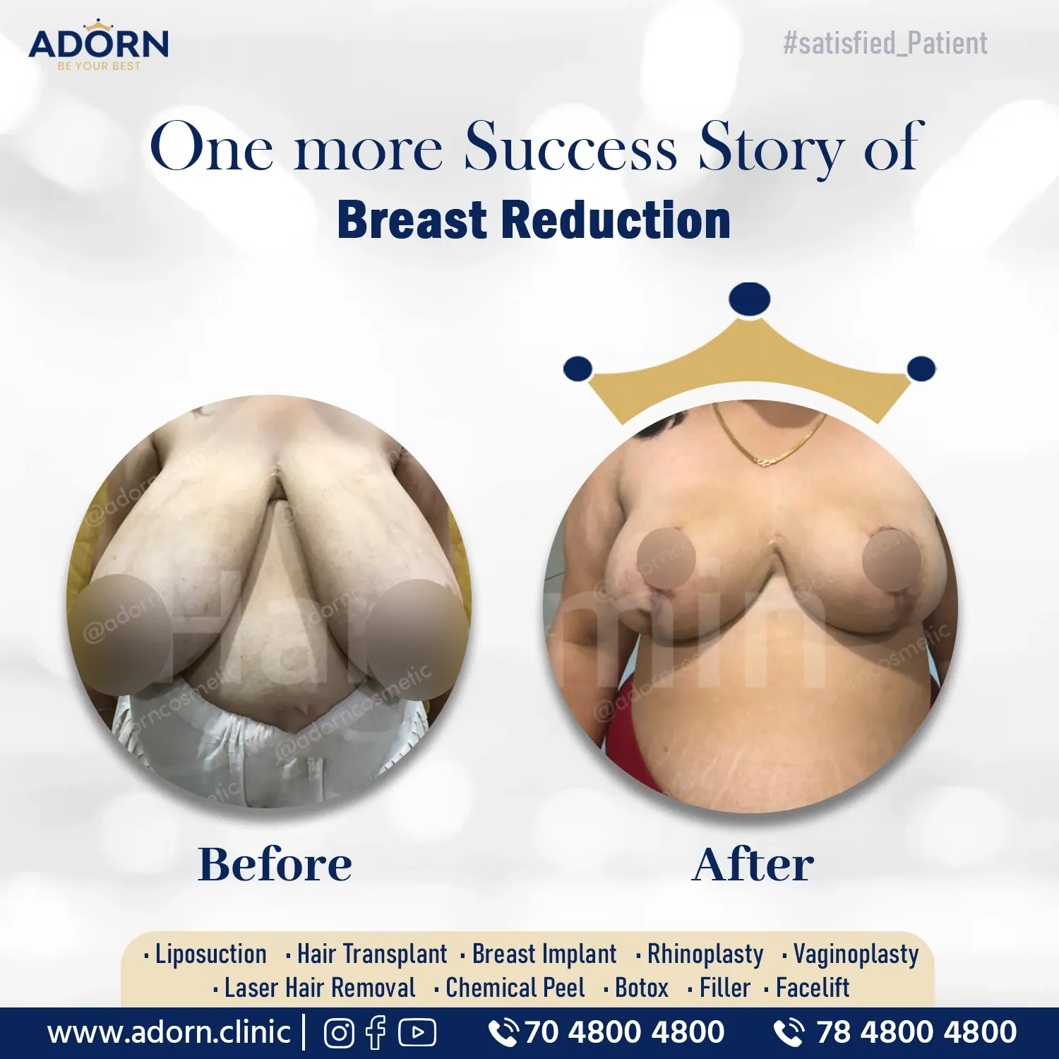 Breast reeducation surgery ahmedabad result 