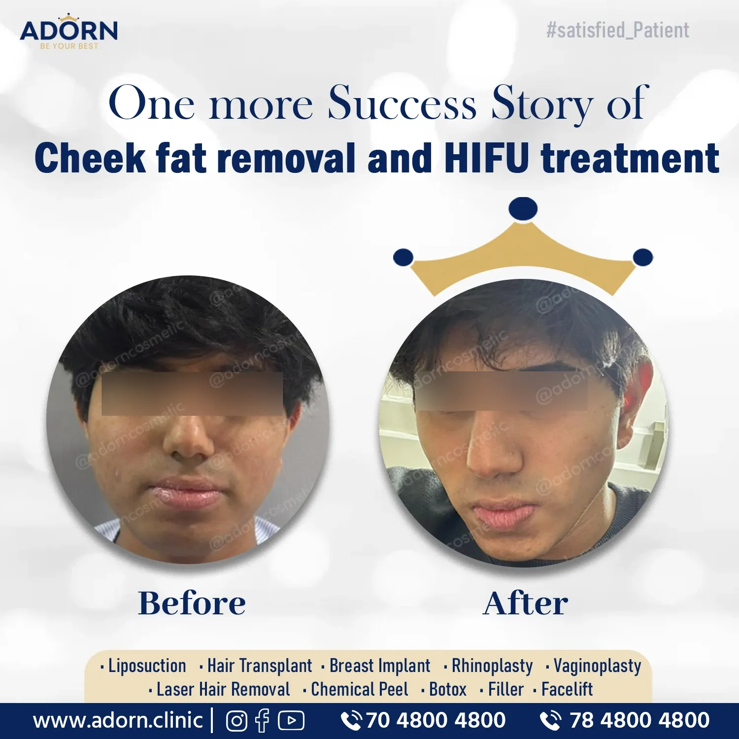 Cheek fat removal HIFU treatment 