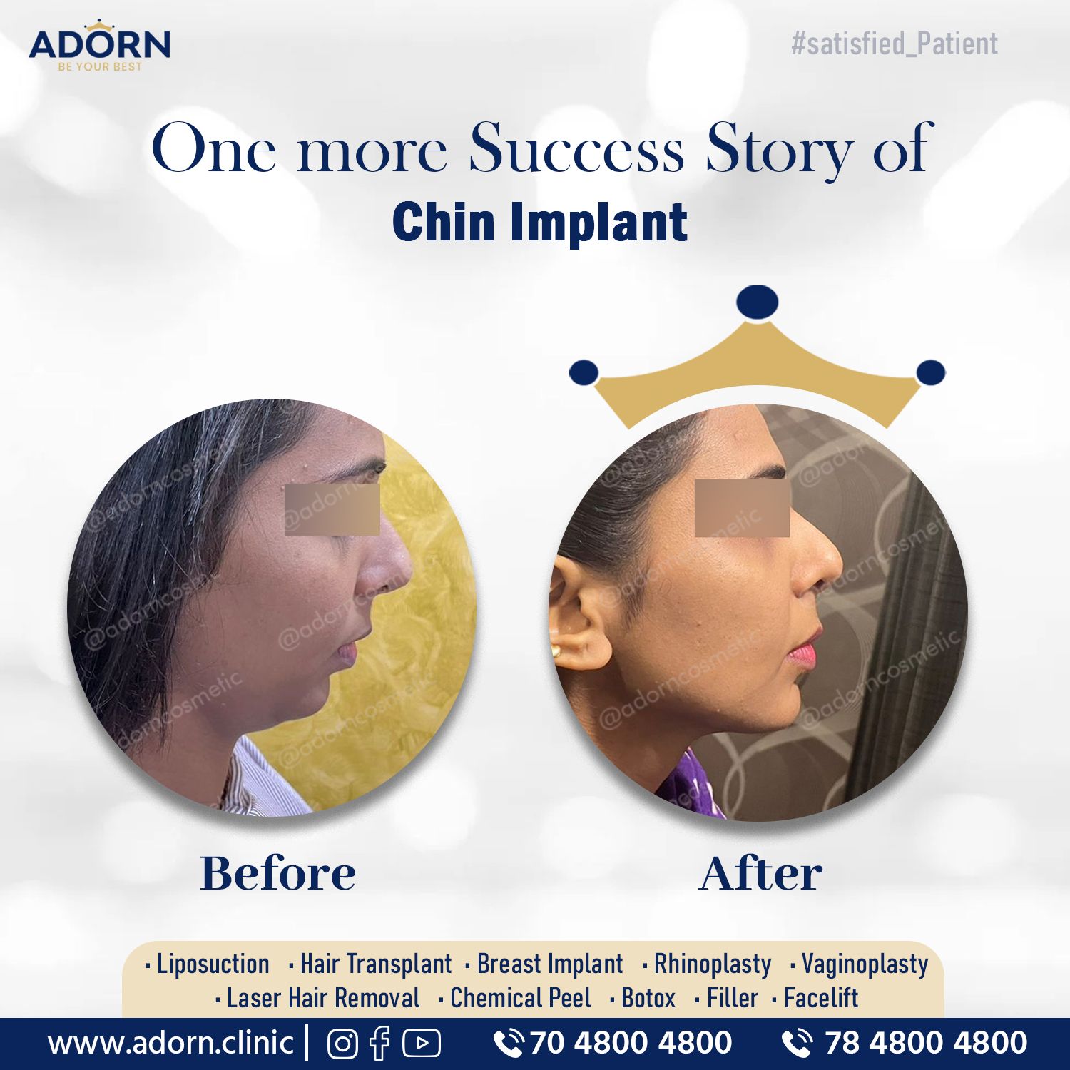 Chin Implant before after results Ahmedabad India 