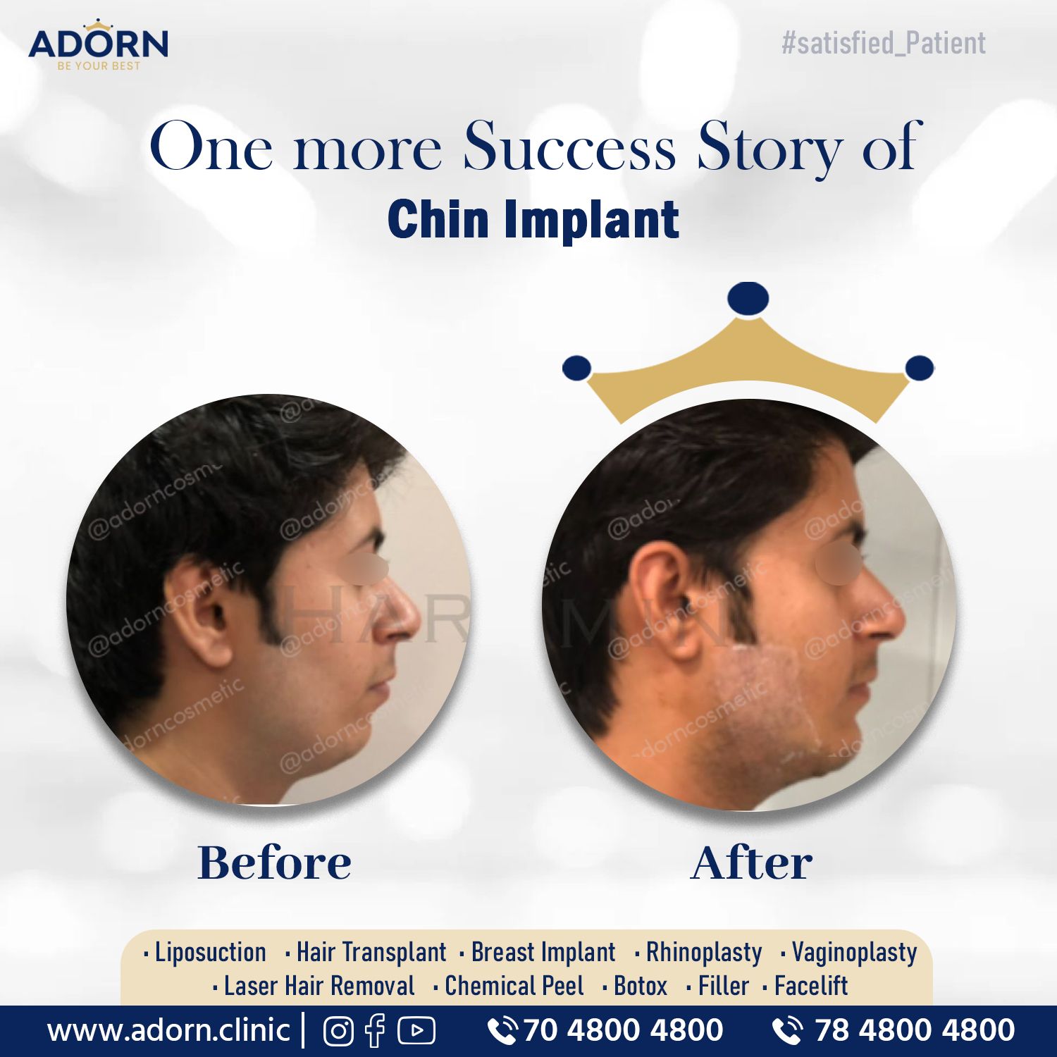 Chin implant before after results Ahmedabad India 