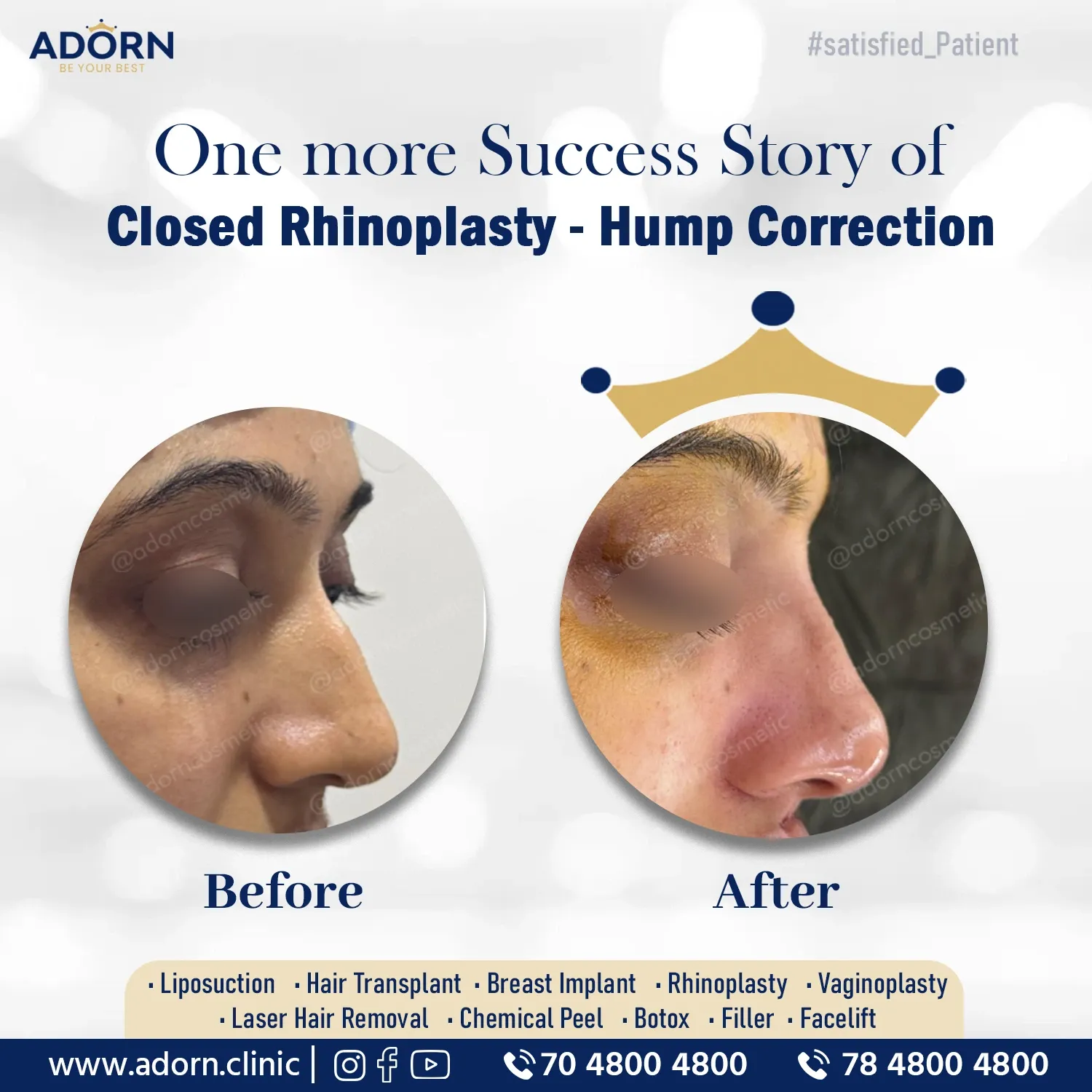 Closed rhinoplasty hump removal