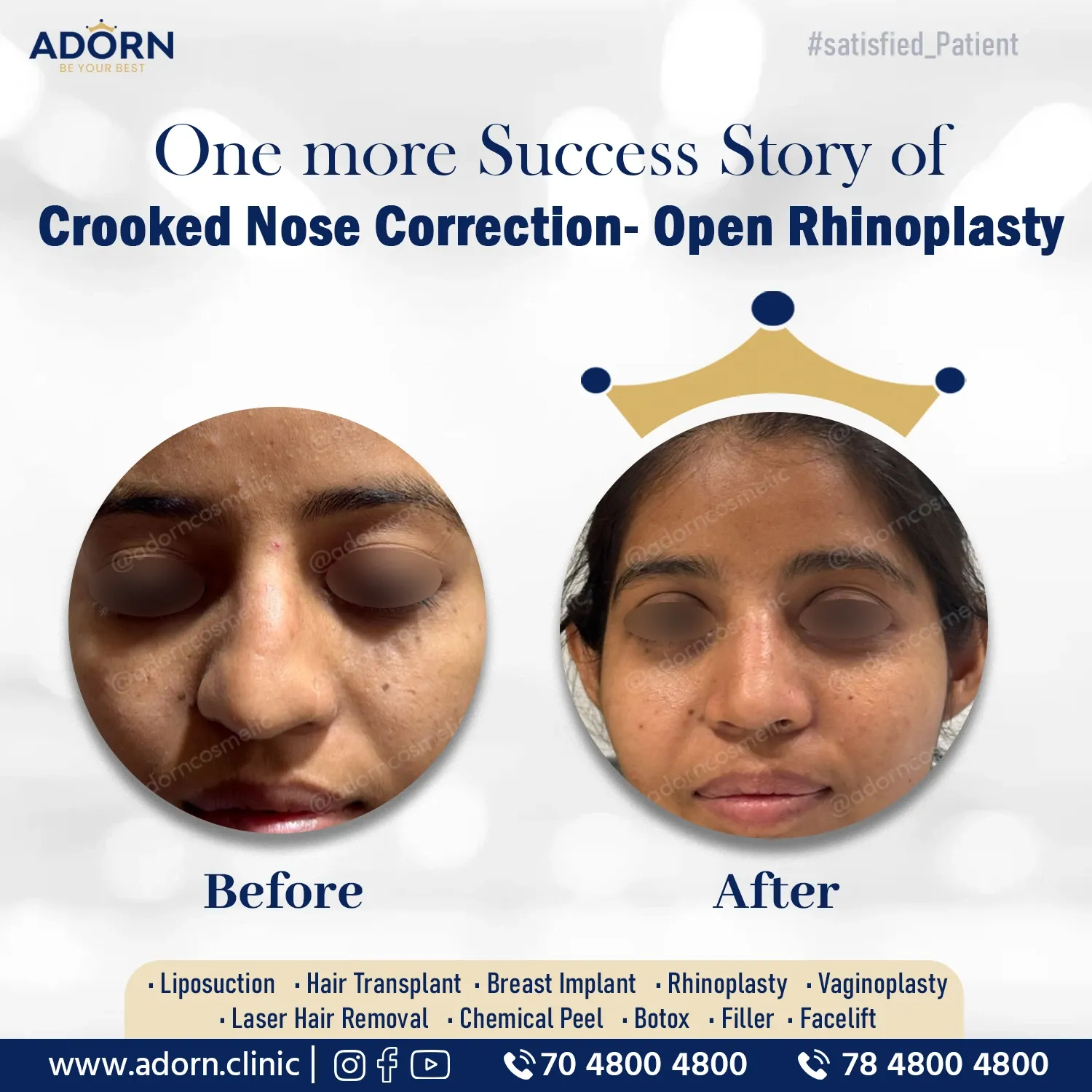Crooked nose open rhinoplasty septoplasty Ahmedabad