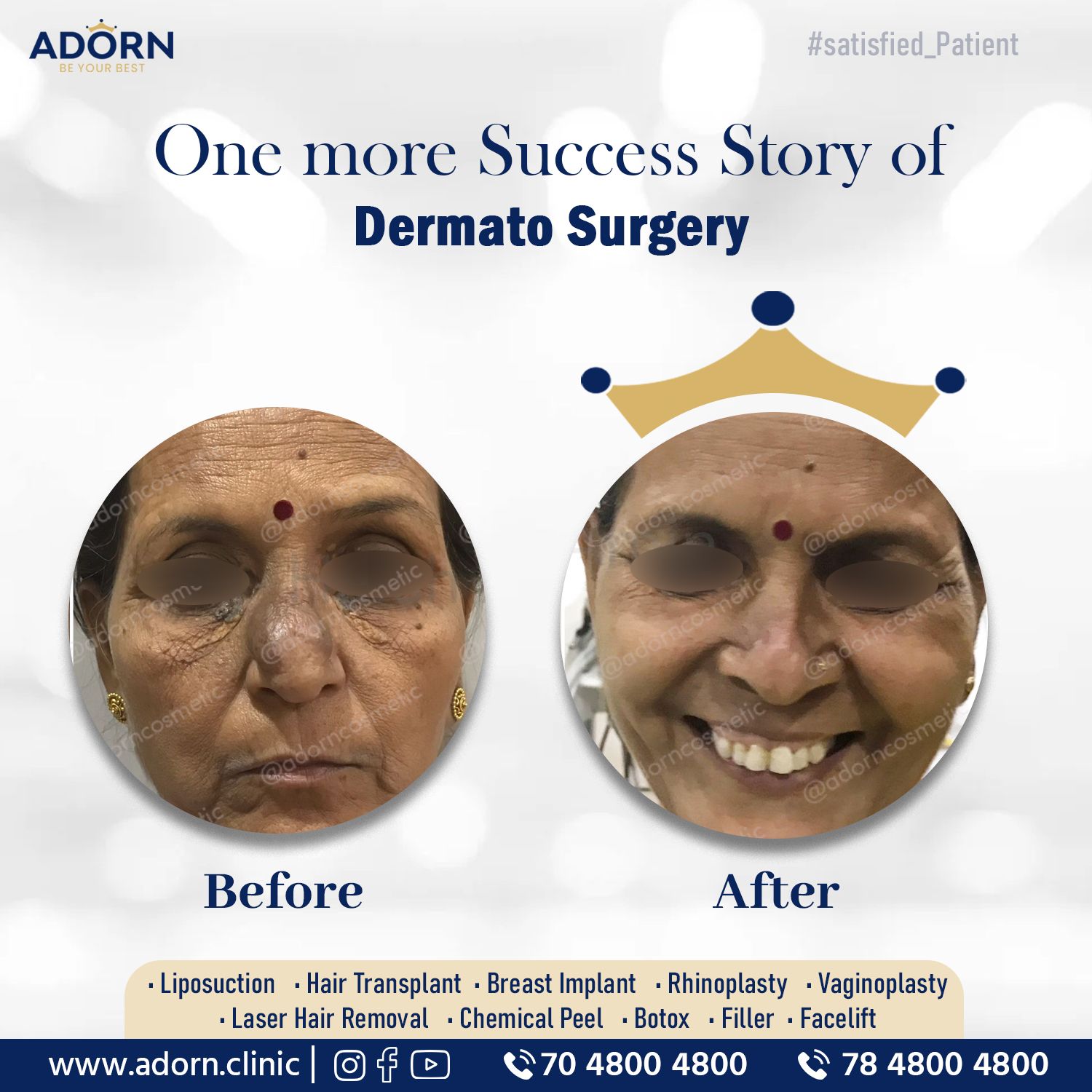 Sebaceous cyst Xanthelesma skin surgery Ahmedabad