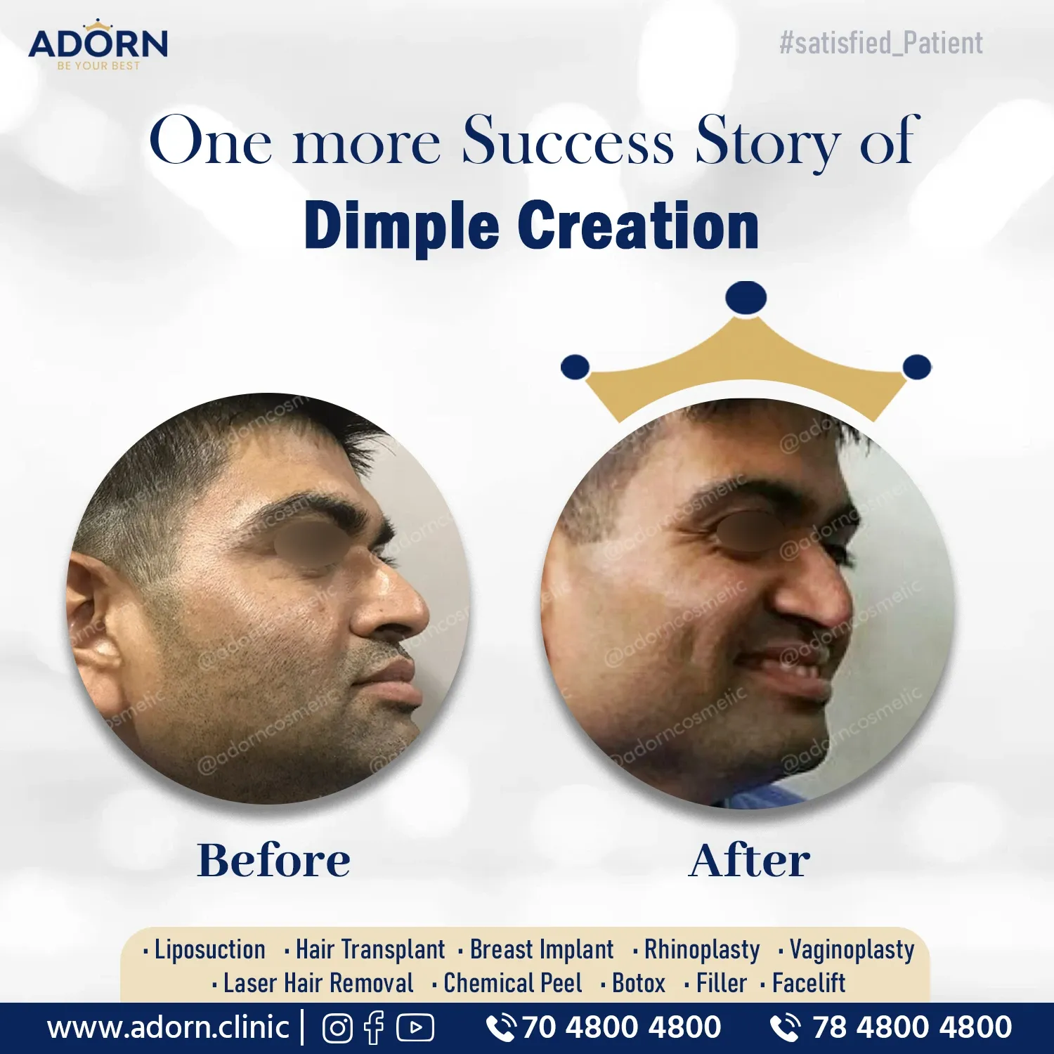 Dimple surgery India Ahmedabad