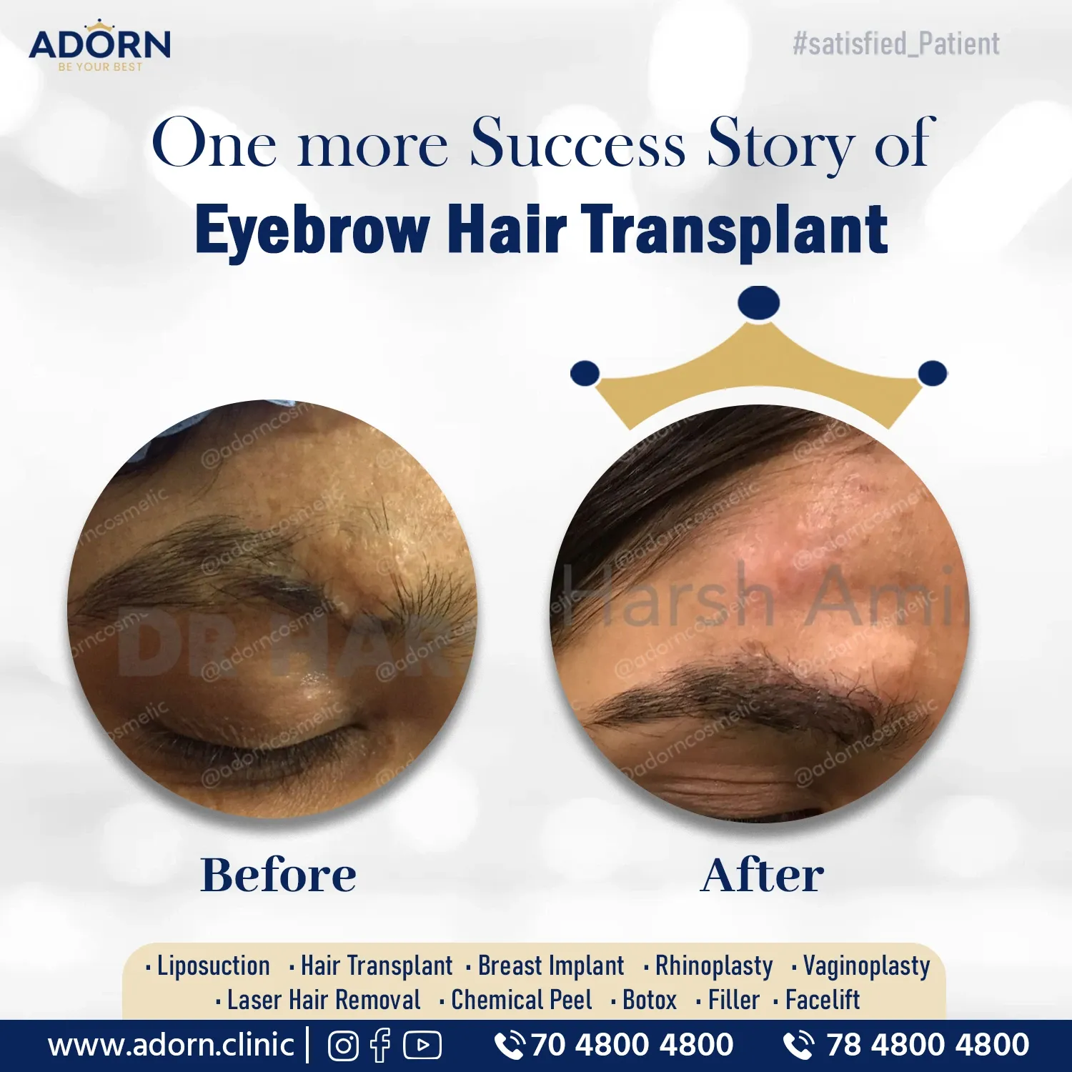 Eyebrow hair transplant Ahmedabad