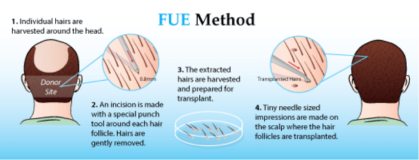 FUE-hair-transplanttion-india