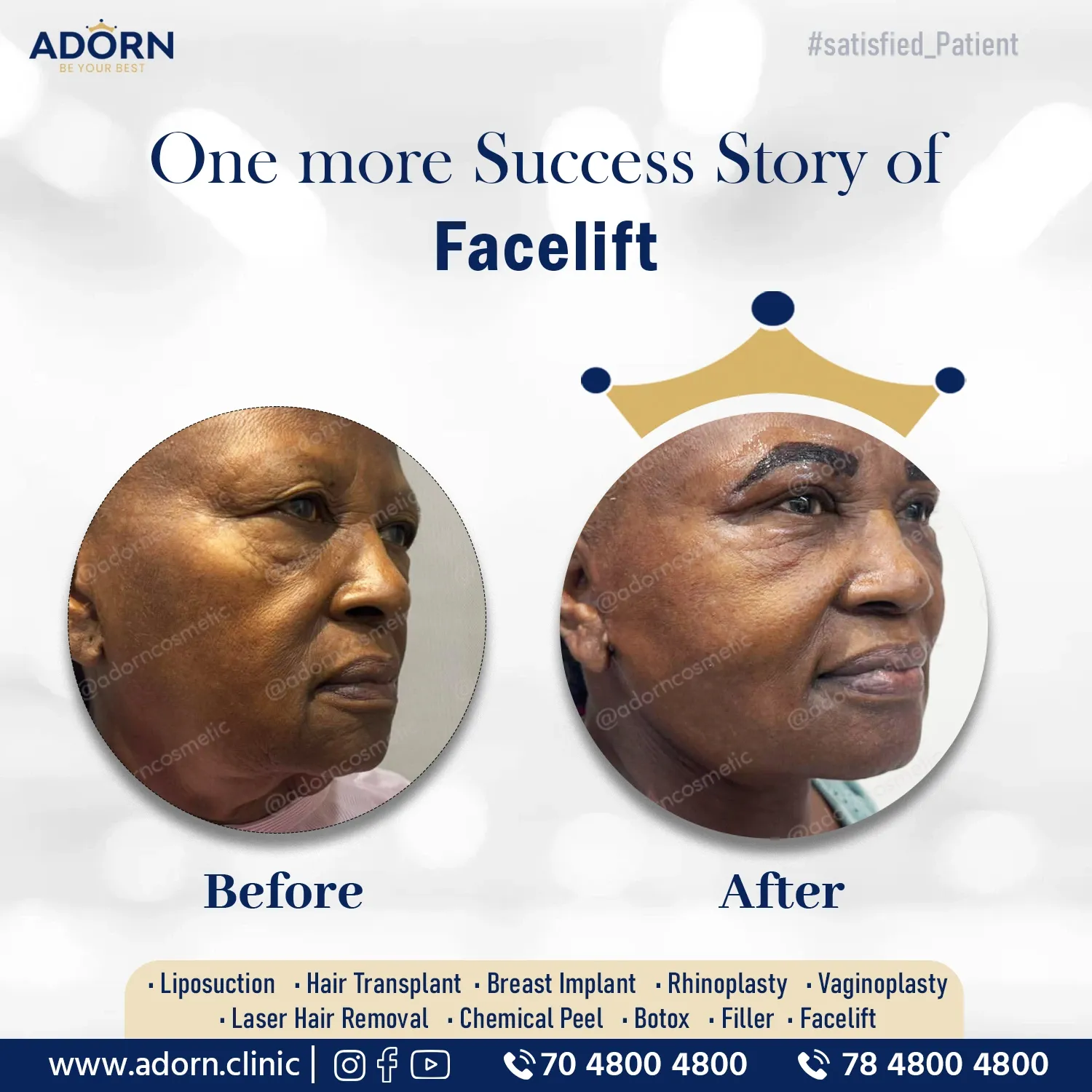 Facelift surgery Ahmedabad India before after results cost