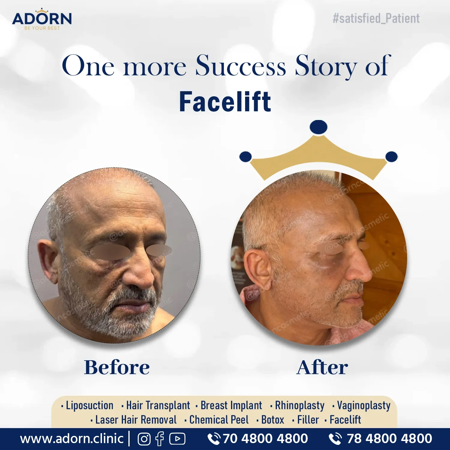 Facelift results India before after Ahmedabad