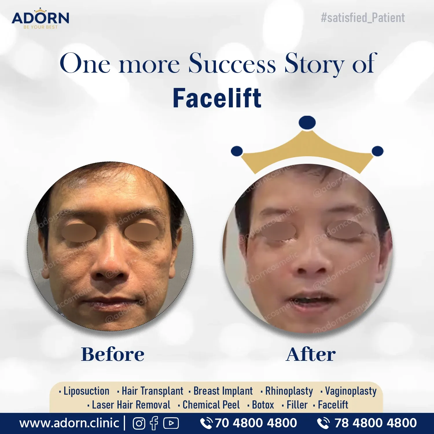 Facelift results India before after Ahmedabad