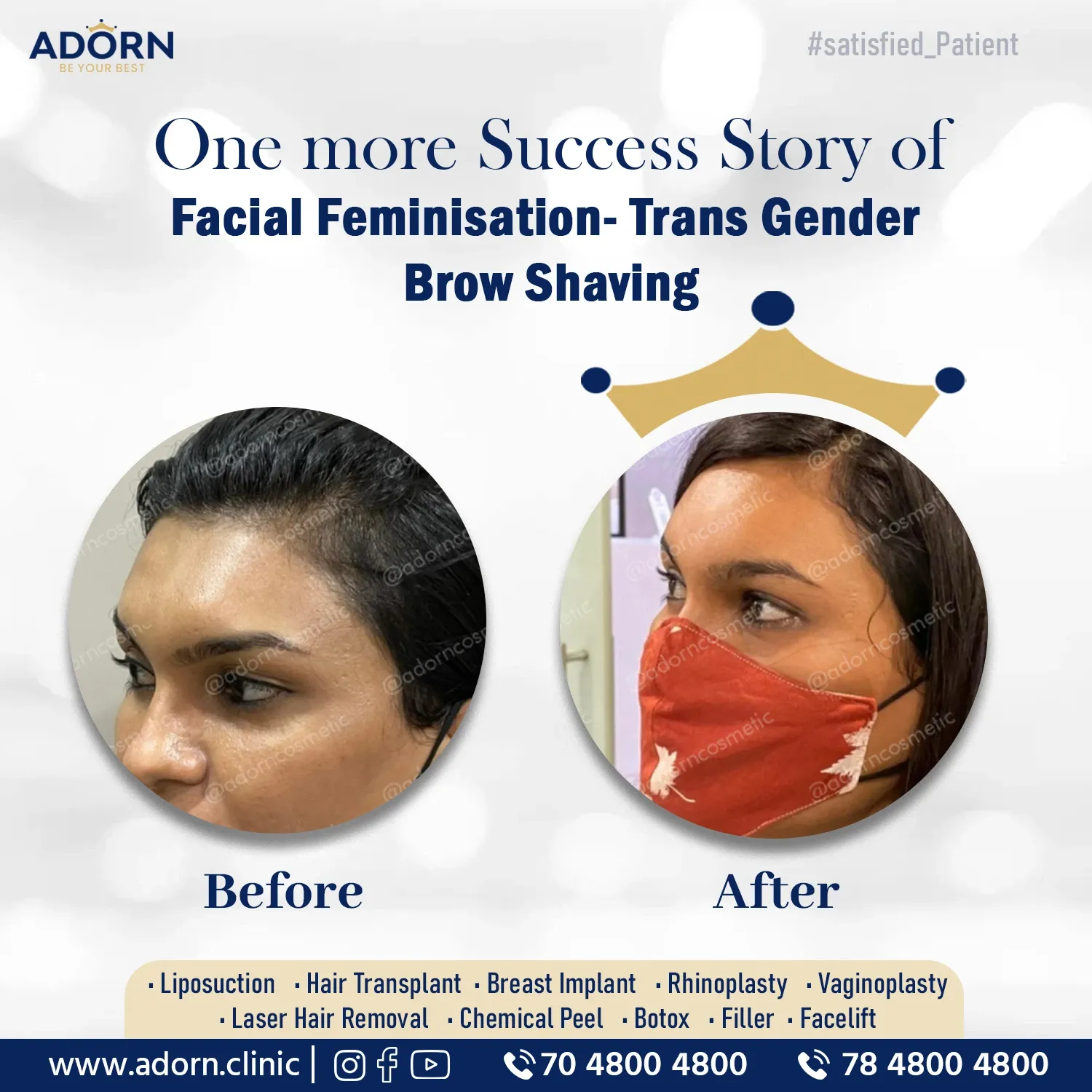 Transgender facial feminisation surgery