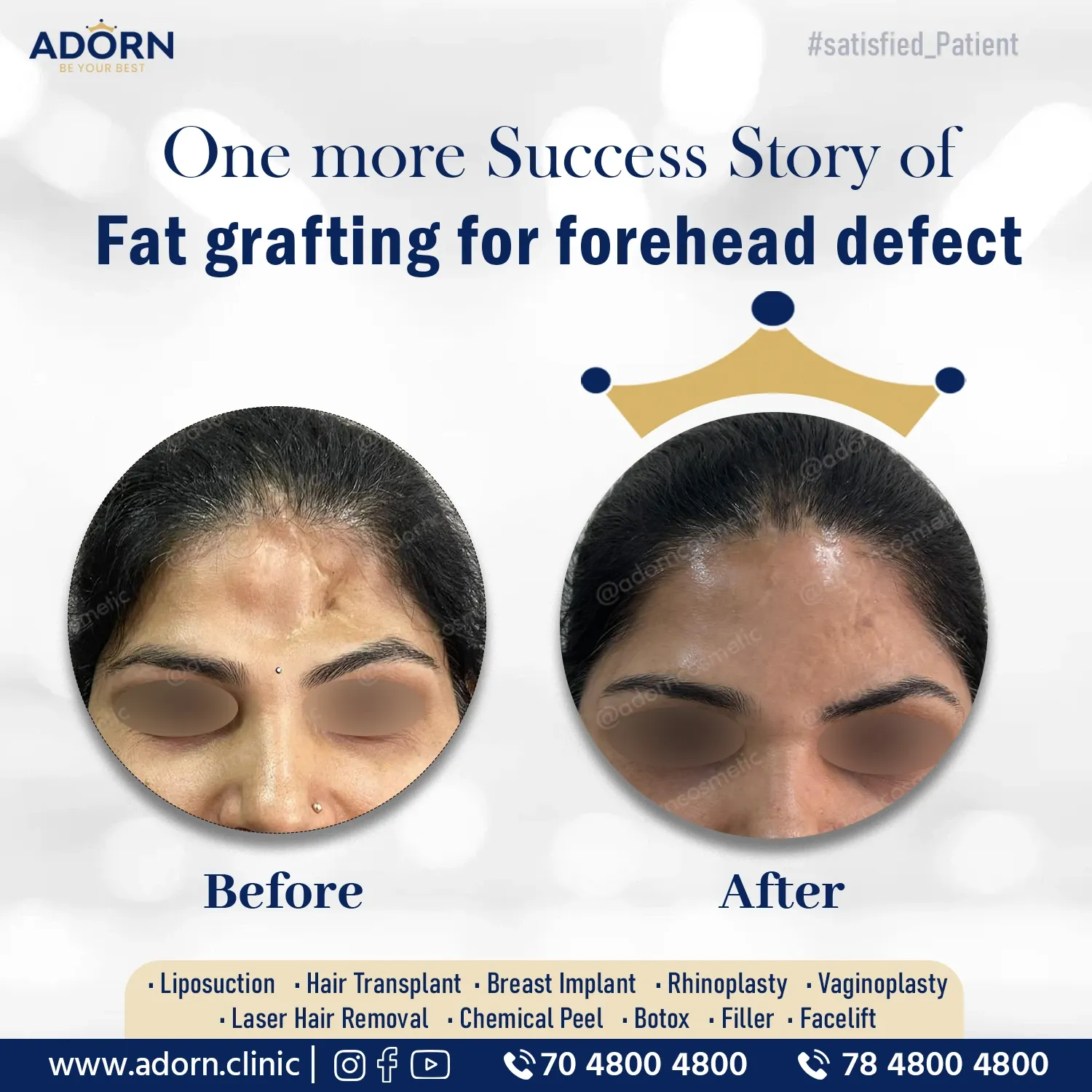 Fat grafting Ahmedabad India Plastic Surgery Before After 