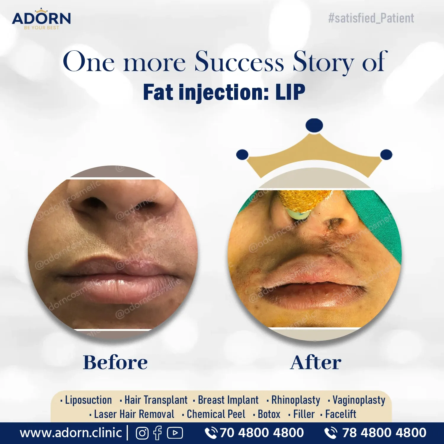 Face fat grafting injection before after results Ahmedabad