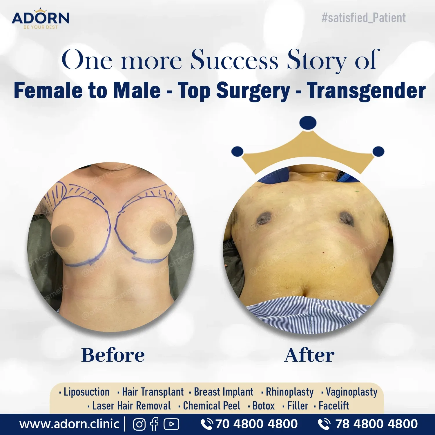 Transgender top surgery breast removal 