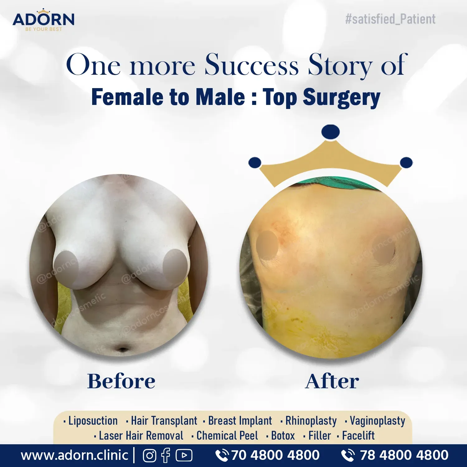 Top surgery female to male trans gender Ahmedabad