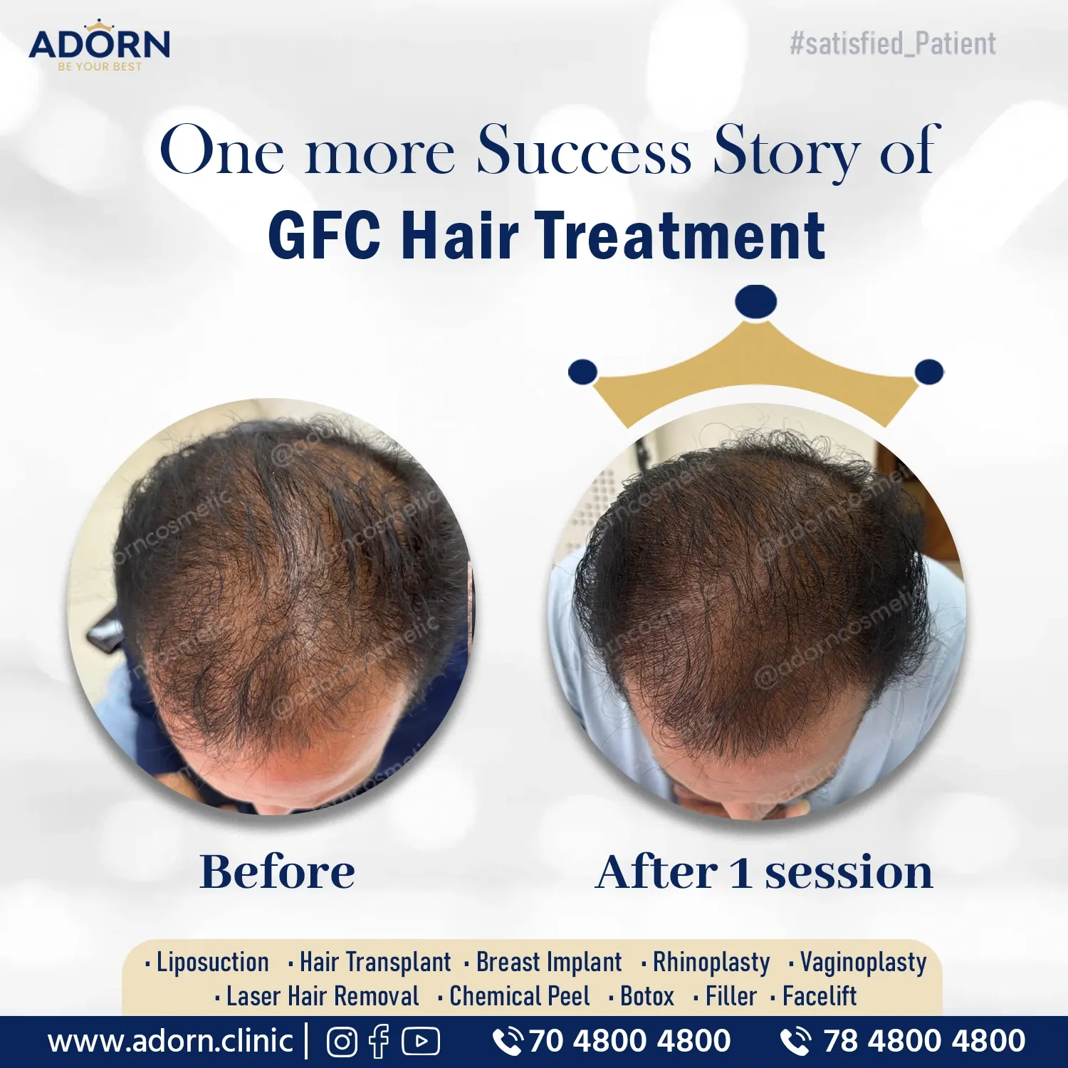 GFC hair Treatment in Ahmedabad Gujarat 
