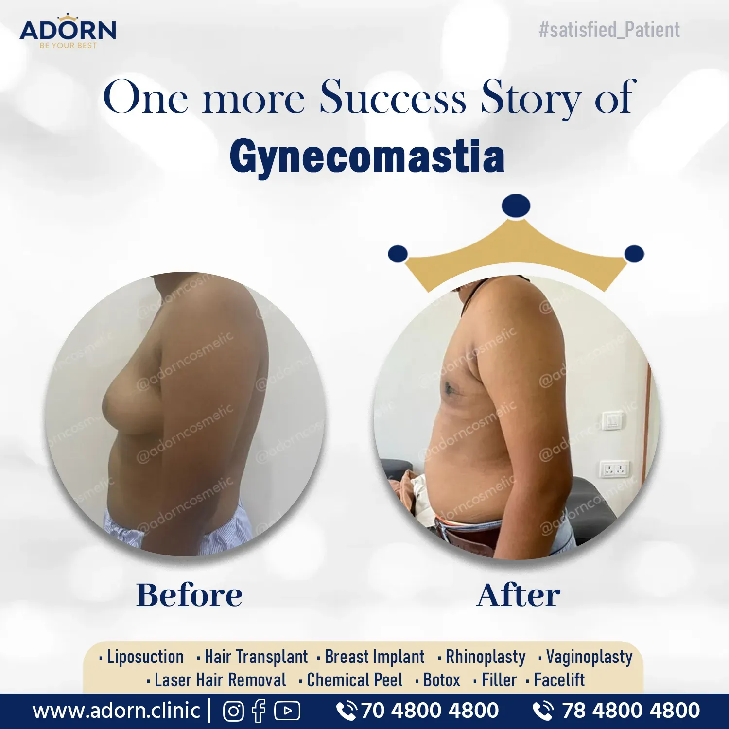 Gynecomastia surgery India Ahmedabad