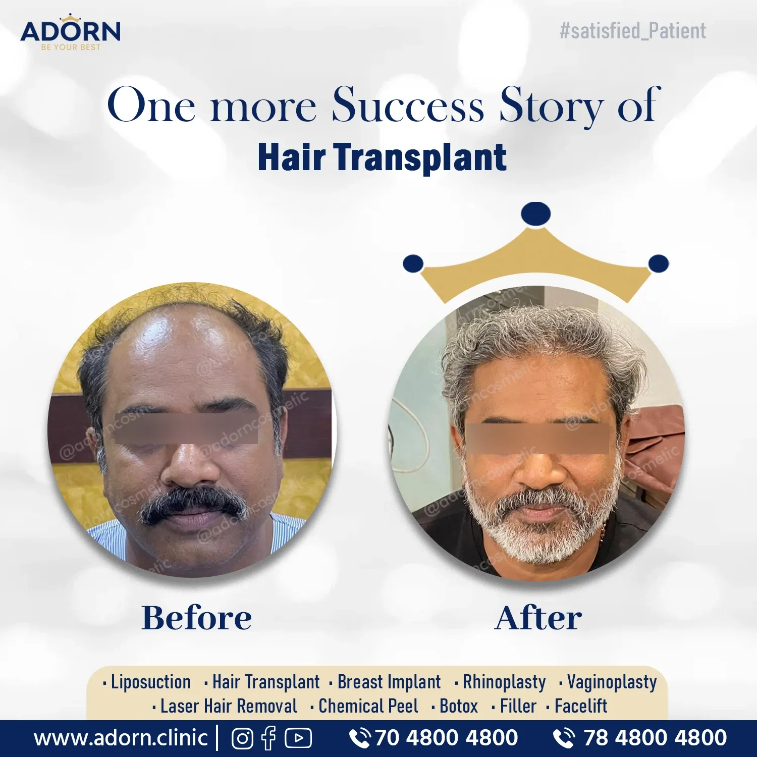 Hair transplant results gujarat before after Ahmedabad India 