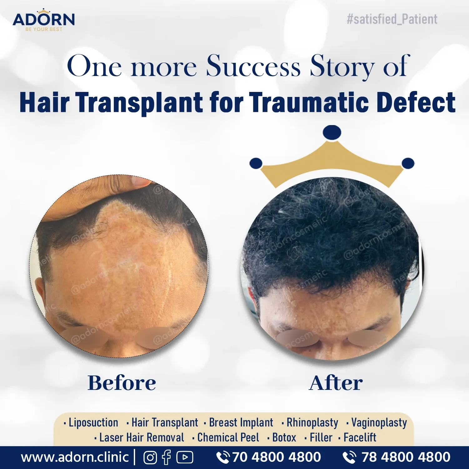 Best Hair Transplant in Ahmedabad India before after results cost