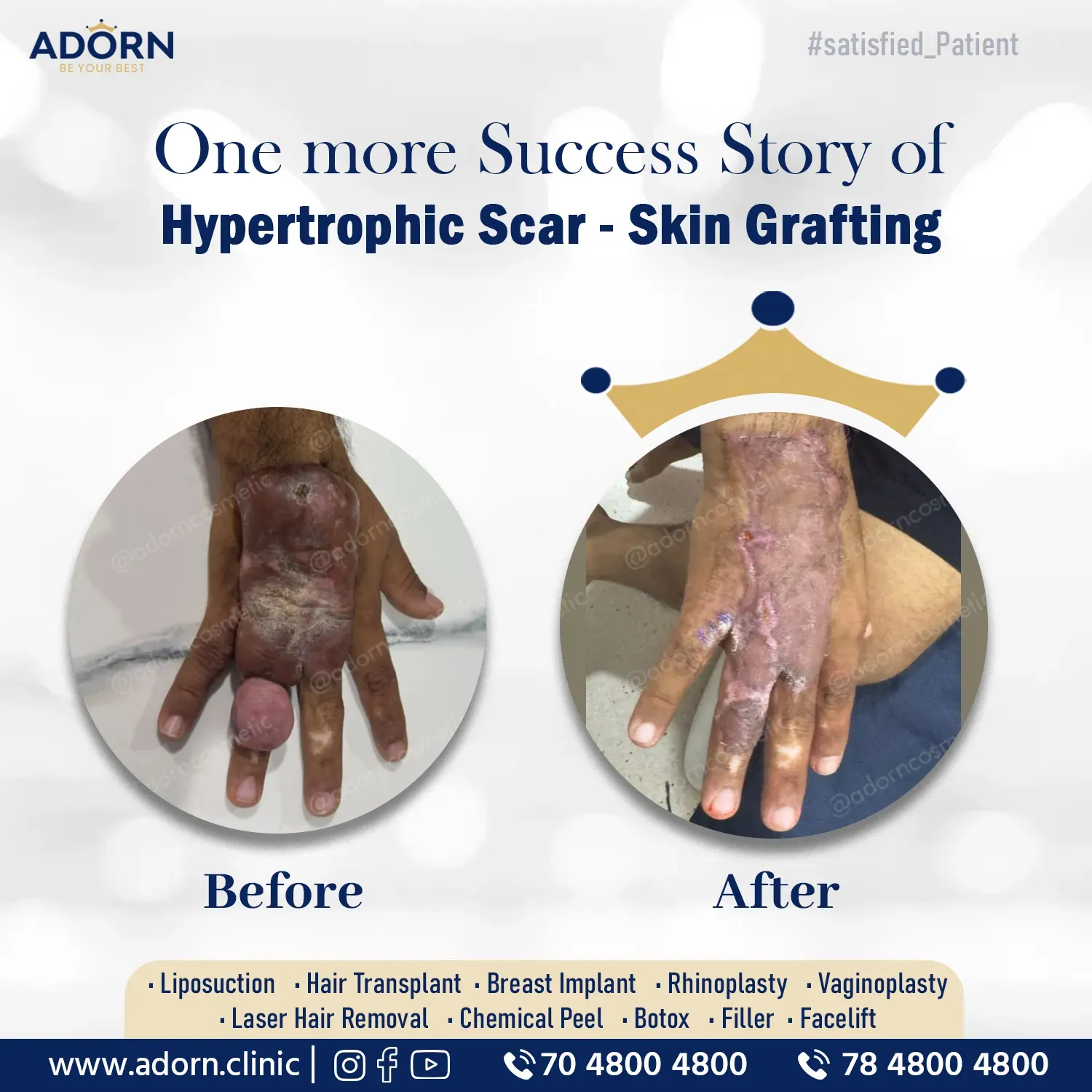Post burn scar surgery Ahmedabad India