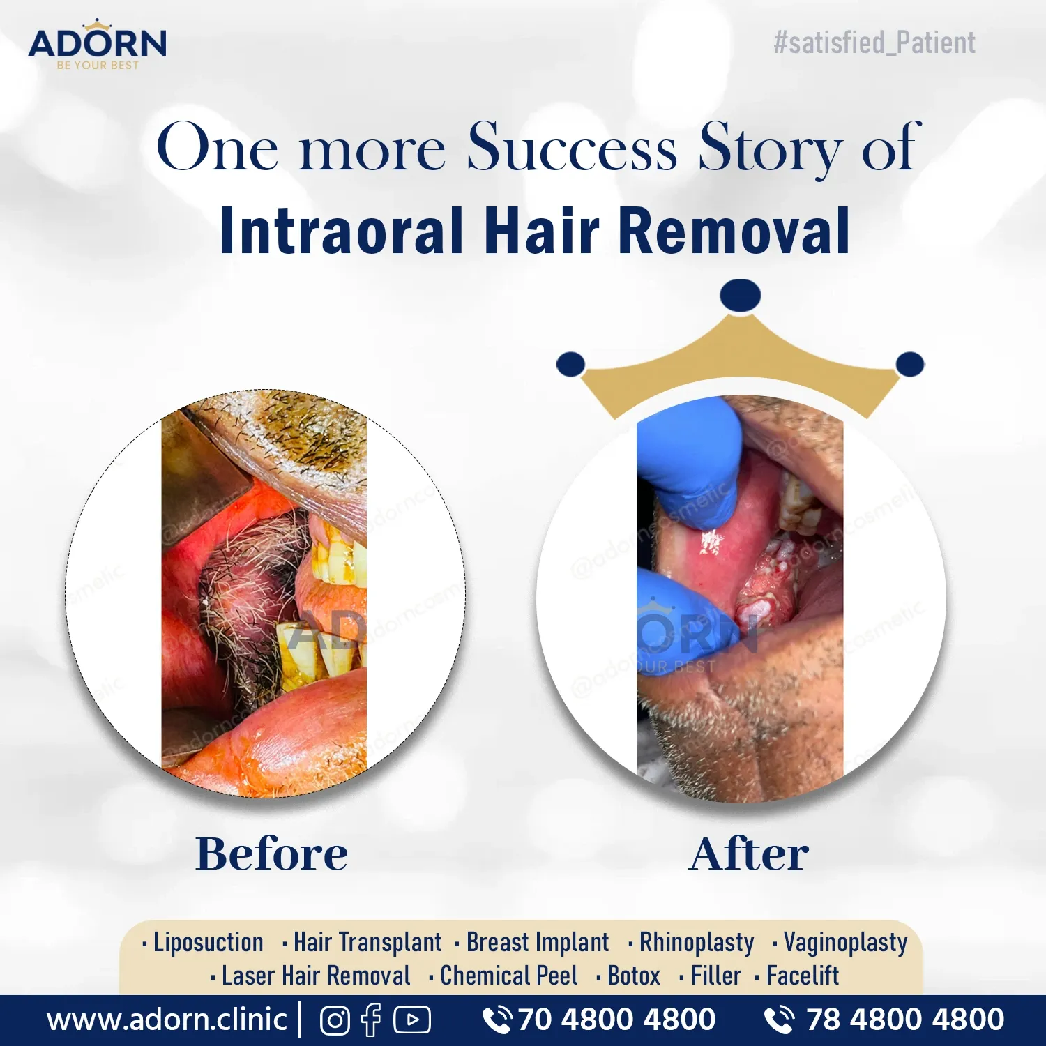 Ahmedabad India Plastic Surgery Before After 