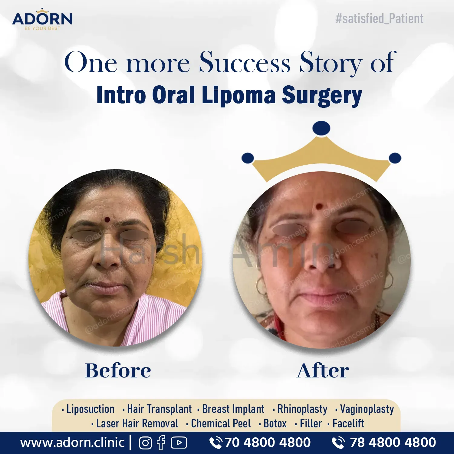 Lipoma removal surgery Ahmedabad Gujarat before after results 