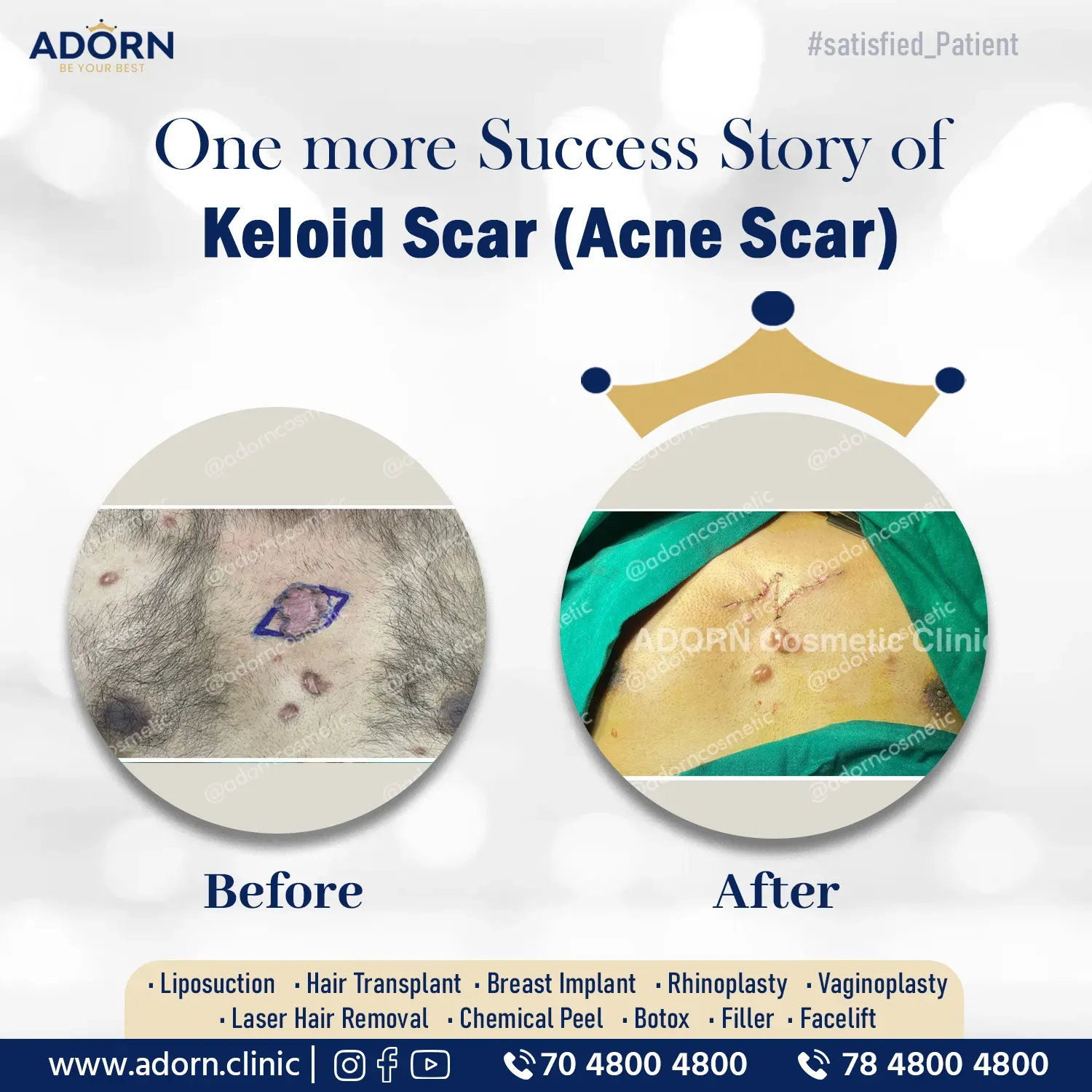 Acne Keloid scar treatment surgery