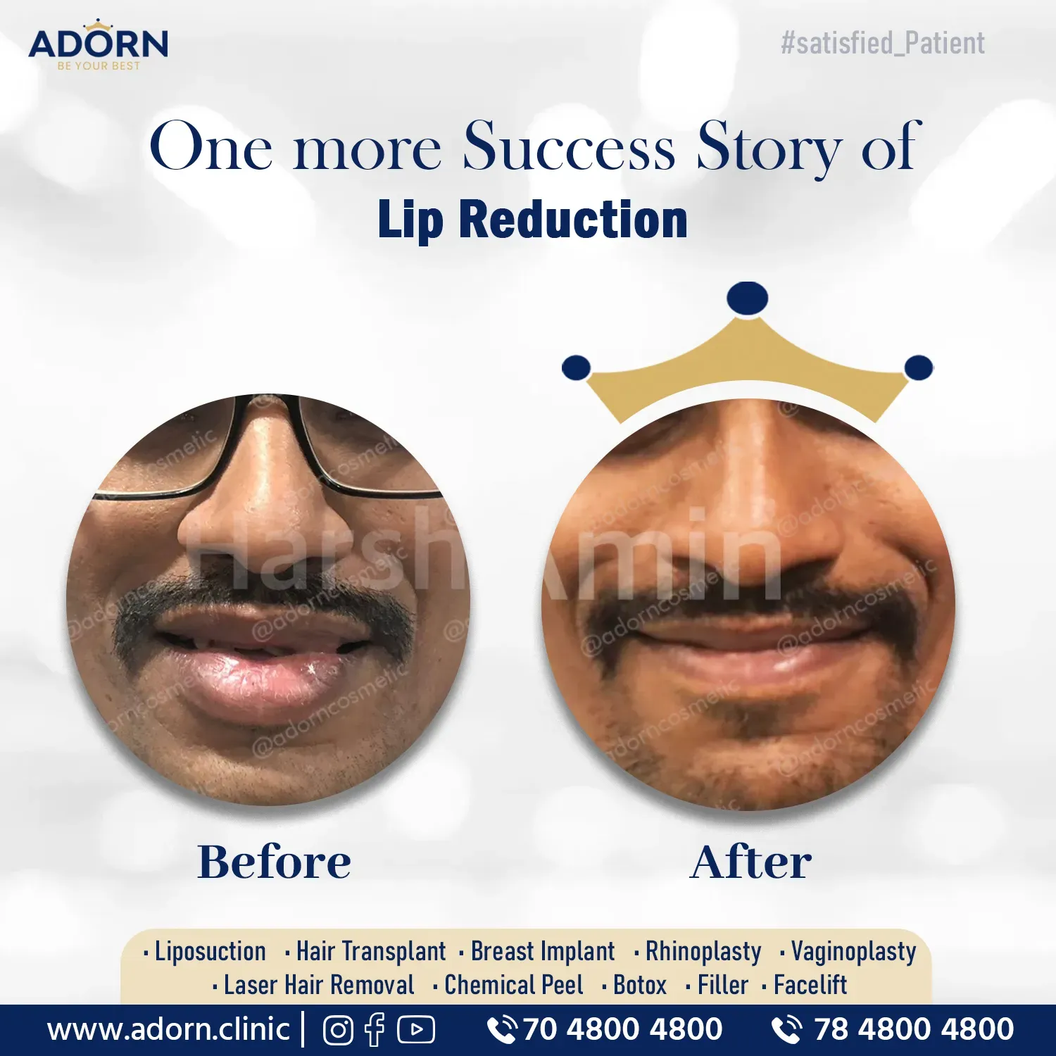  Lip reduction Surgery Ahmedabad Gujarat India