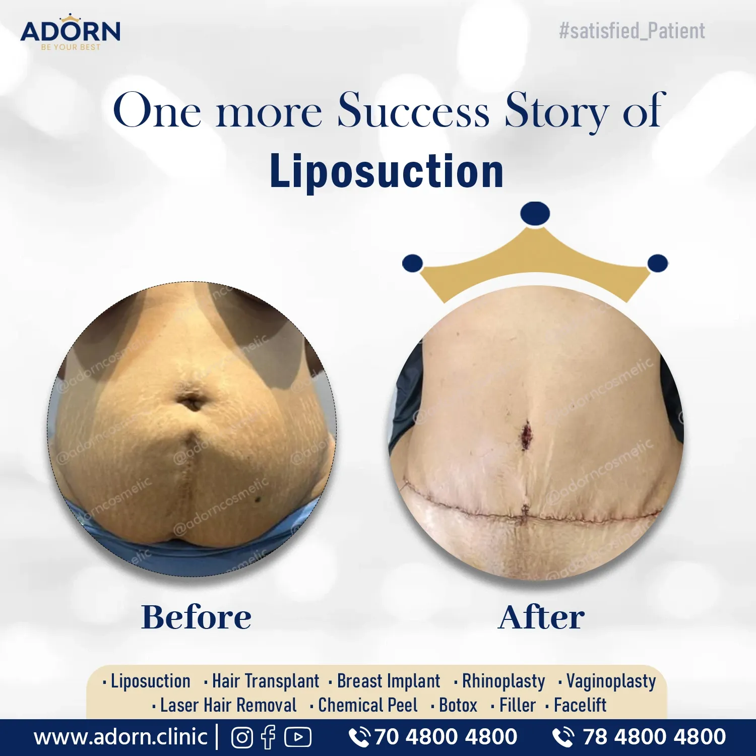 TummyTuck surgery results India before after Ahmedabad