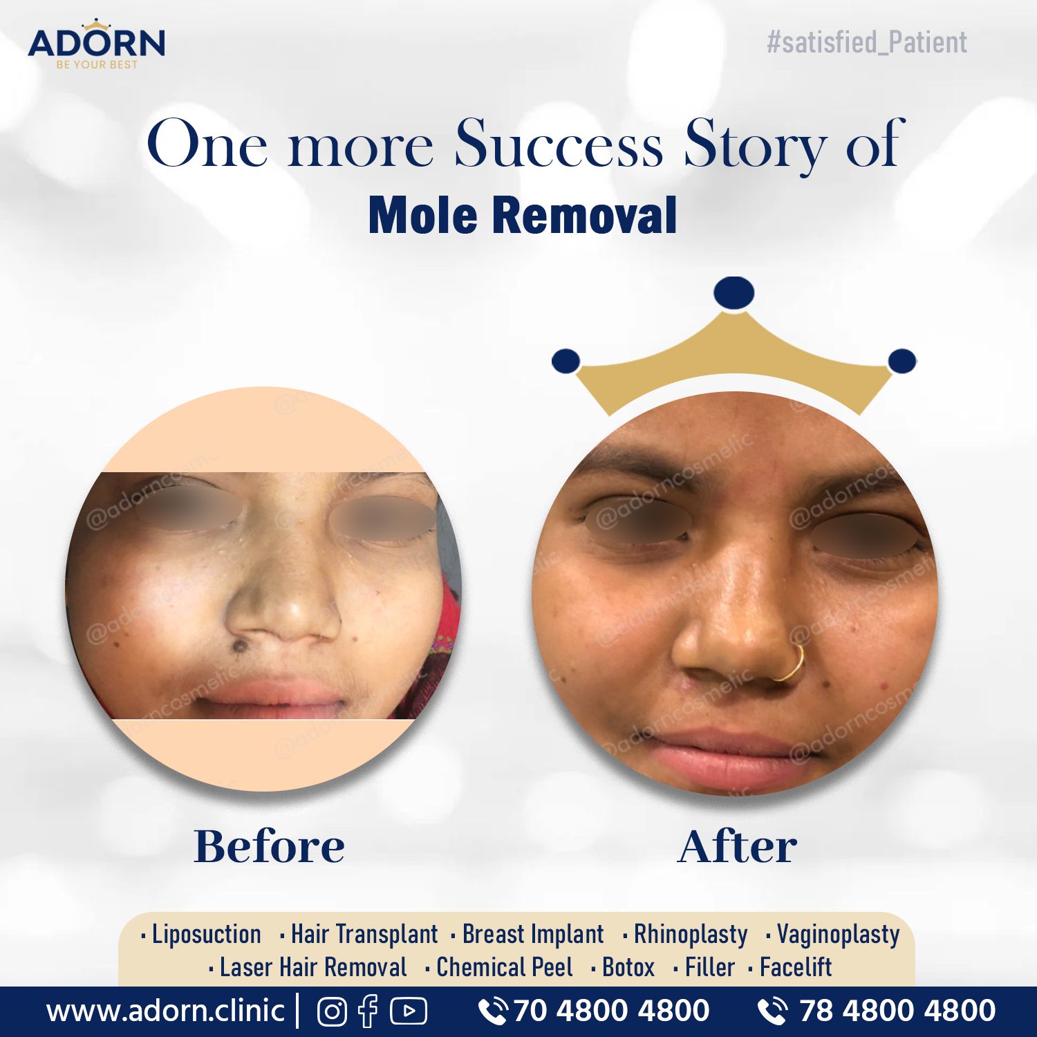 Mole removal skin Surgery Before After results in Ahmedabad
