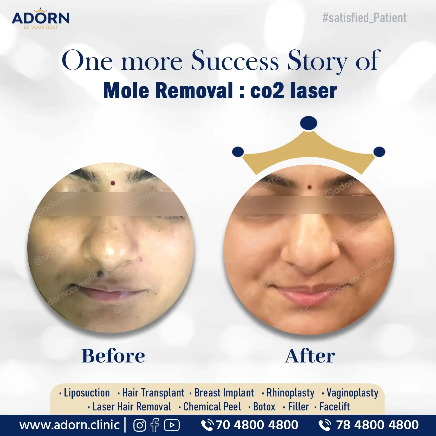 Laser mole skin removal treatment Ahmedabad results before after
