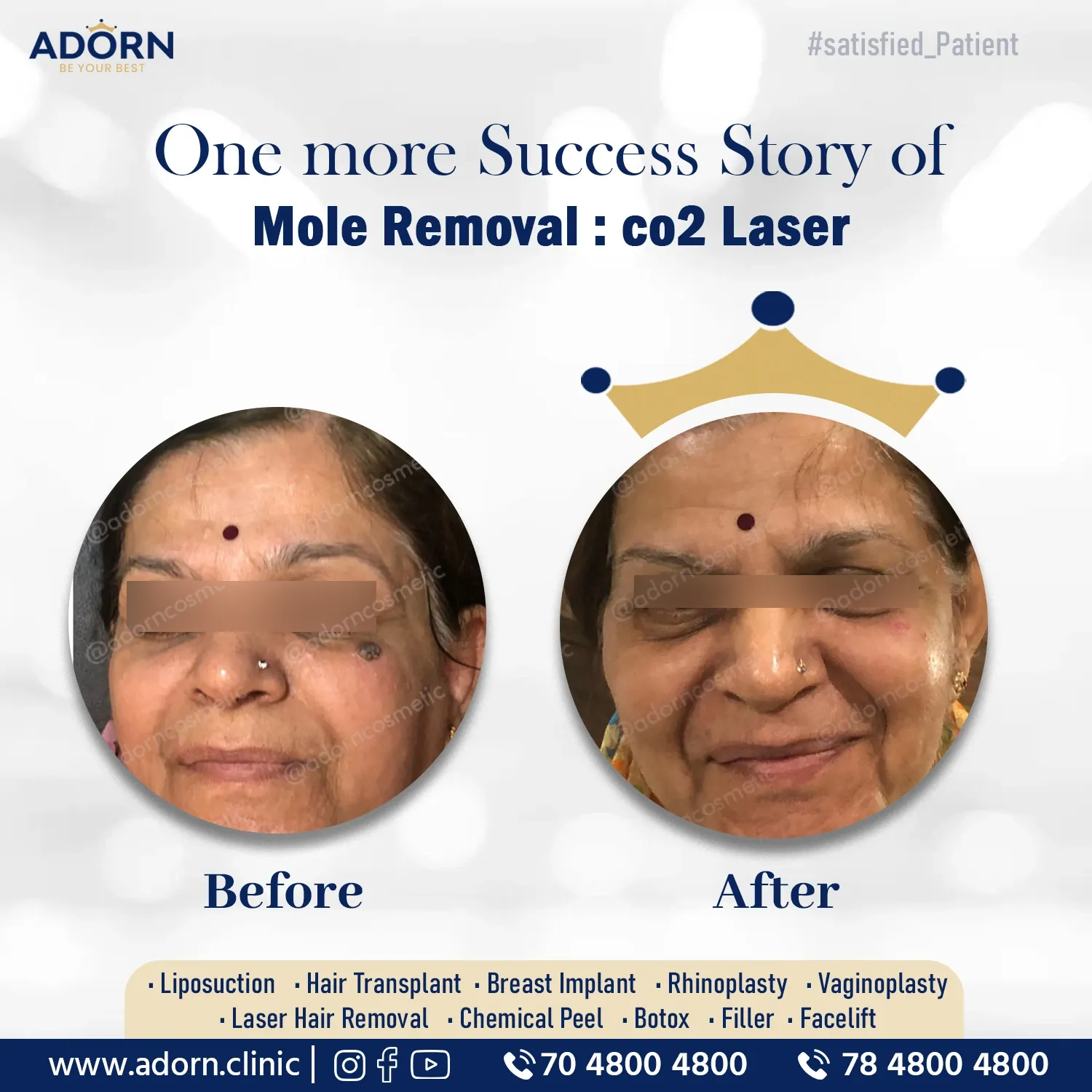 Laser mole removal before after results Ahmedabad Gujarat