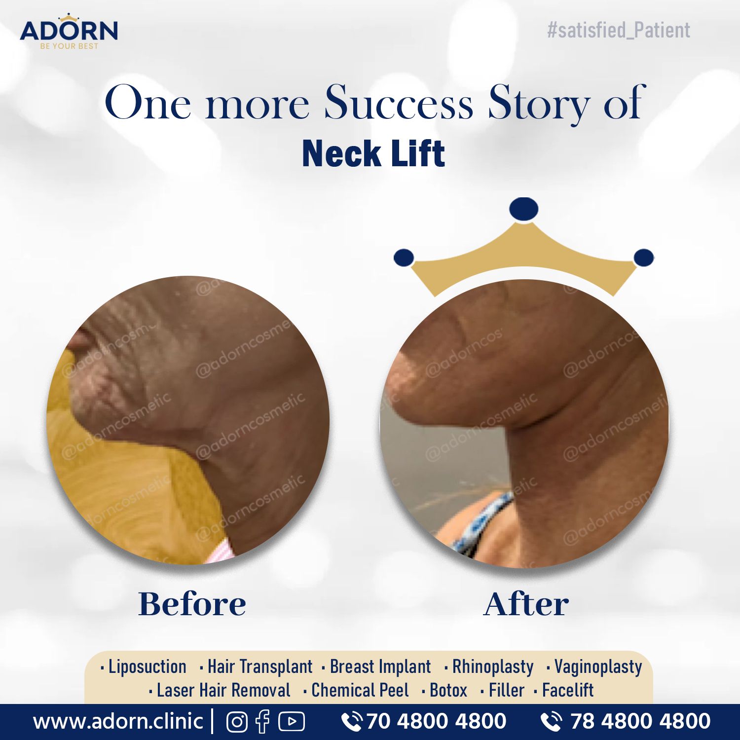 Neck lift Plastic surgery in India Results before after