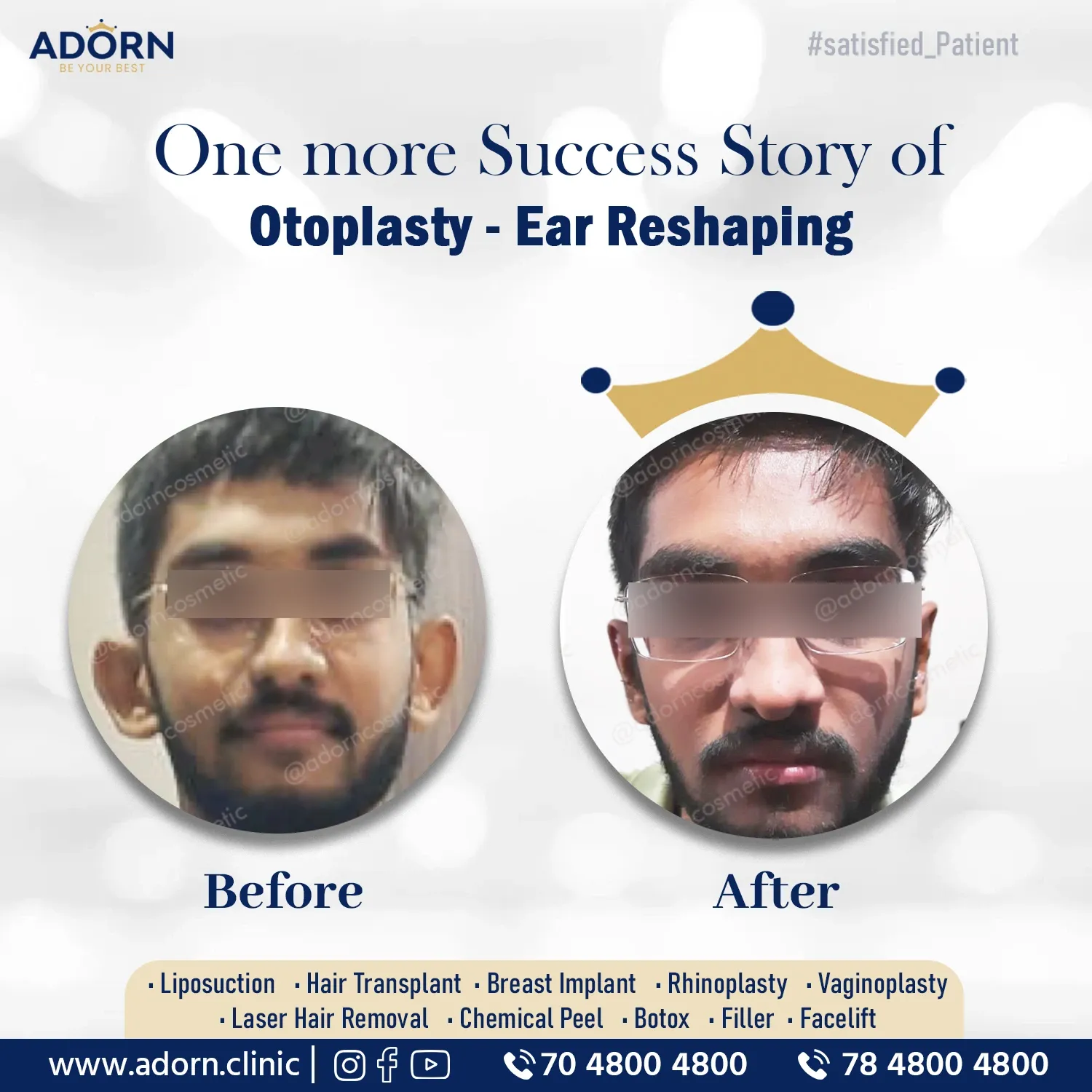 Ear reshaping Otoplasty Ahmedabad Before After results 